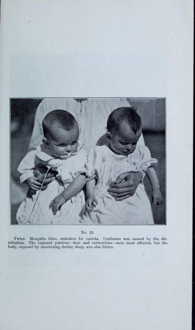 Twins. Mosquito bites, mistaken for variola. Confusion was caused by the dis- tribution. The exposed portions—face and extremities—were most affected, but the body, exposed by uncovering during sleep, was also bitten.