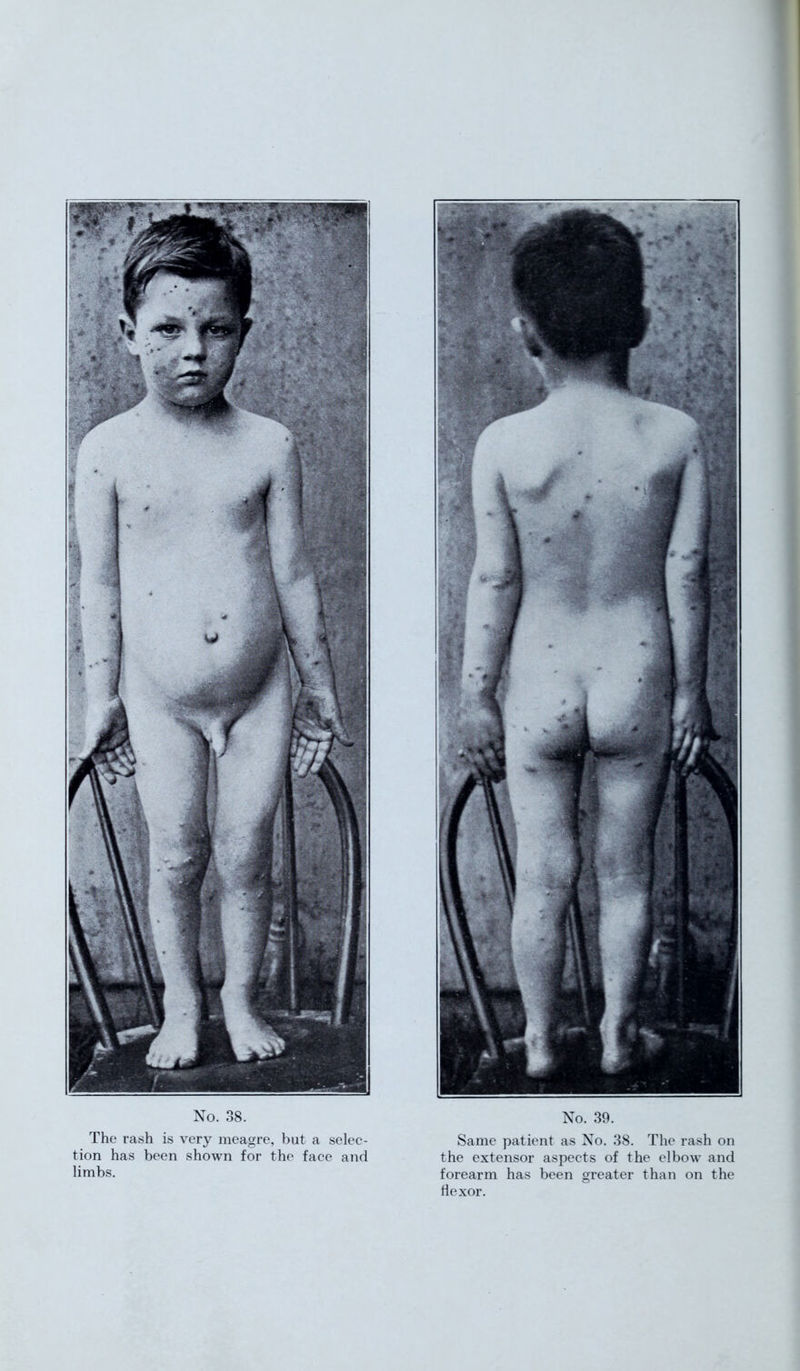 The rash is very meagre, but a selec- tion has been shown for the face and limbs. Same patient as No. 38. The rash on the extensor aspects of the elbow and forearm has been greater than on the flexor.