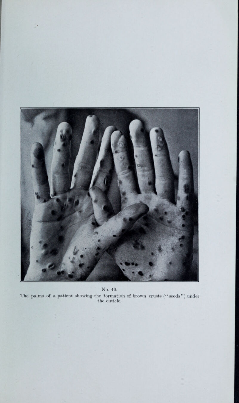 No. 40. The palms of a patient showing the formation of brown crusts (“seeds”) under the cuticle.