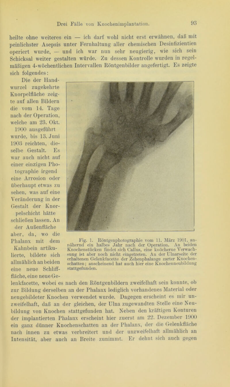 heilte ohne weiteres ein — ich darf wohl nicht erst erwähnen, daß mit peinlichster Asepsis unter Fernhaltung aller chemischen Desinfizientien operiert wurde, — und ich war nun sehr neugierig, wie sich sein Schicksal weiter gestalten würde. Zu dessen Kontrolle wurden in regel- mäßigen 4-wöchentlichen Intervallen Röntgenbilder angefertigt. Es zeigte sich folgendes: Die der Hand- wurzel zugekehrte Knorpelfläche zeig- te auf allen Bildern die vom 14. Tage nach der Operation, welche am 23. Okt. 1900 ausgeführt wurde, bis 13. Juni 1903 reichten, die- selbe Gestalt. Es war auch nicht auf einer einzigen Pho- tographie irgend eine Arrosion oder überhaupt etwas zu sehen, was auf eine Veränderung in der Gestalt der Knor- pelschicht hätte schließen lassen. An der Außenfläche aber, da, wo die Phalanx mit dem Kahnbein artiku- lierte, bildete sich allmählich an beiden eine neue Schliff- fläche, eine neue Ge- lenkfacette, wobei es nach den Röntgen bildern zweifelhaft sein konnte, ob zur Bildung derselben an der Phalanx lediglich vorhandenes Material oder neugebildeter Knochen verwendet wurde. Dagegen erscheint es mir un- zweifelhaft, daß an der gleichen, der Ulna zugewandten Stelle eine Neu- bildung von Knochen stattgefunden hat. Neben den kräftigen Konturen der implantierten Phalanx erscheint hier zuerst am 22. Dezember 1900 ein ganz dünner Knochenschatten an der Phalanx, der die Gelenkfläche nach innen zu etwas verbreitert und der unzweifelhaft allmählich an Intensität, aber auch an Breite zunimmt. Er dehnt sich auch gegen Fig. 1. Köntgenphotographie vom 11. März 1901, an- nähernd ein halbes Jahr nach der Operation. An beiden Knochenstücken findet sich Gallus, eine knöcherne Verwach- sung ist aber noch nicht eingetreten. An der Ulnarseite der erhaltenen Gelenkfacette der Zehenphalange zarter Knochen- schatten; anscheinend hat auch hier eine Knochenneubildung stattgefunden.