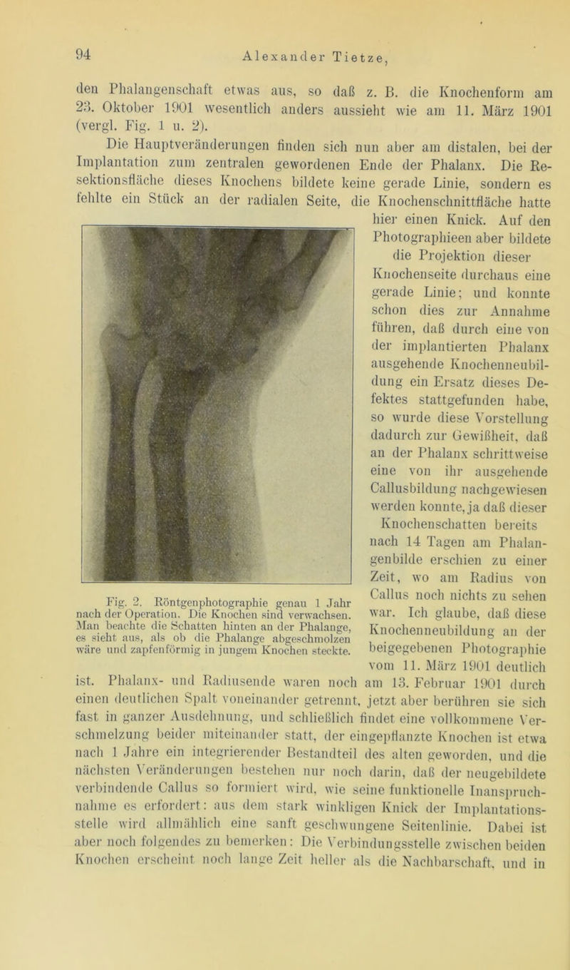 den Phalangenschaft etwas aus, so daß z. B. die Knochenform am 24. Oktober 1901 wesentlich anders aussieht wie am 11. März 1901 (vergl. Fig. 1 u. 2). Die Hauptveränderungen linden sich nun aber am distalen, bei der Implantation zum zentralen gewordenen Ende der Phalanx. Die Re- sektionsfläche dieses Knochens bildete keine gerade Linie, sondern es fehlte ein Stück an der radialen Seite, die Knochenschnittfläche hatte hier einen Knick. Auf den Photographieen aber bildete die Projektion dieser Knochenseite durchaus eine gerade Linie; und konnte schon dies zur Annahme führen, daß durch eine von der implantierten Phalanx ausgehende Knochenneubil- dung ein Ersatz dieses De- fektes stattgefunden habe, so wurde diese Vorstellung dadurch zur Gewißheit, daß an der Phalanx schrittweise eine von ihr ausgehende Callusbildung nach gewiesen werden konnte, ja daß dieser Knochenschatten bereits nach gen bilde erschien 14 Tagen am Phalan- Fig. 2. Röntgenphotographie genau 1 Jahr nach der Operation. Die Knochen sind verwachsen. Man beachte die Schatten hinten an der Phalange, es sieht aus, als ob die Phalange abgeschmolzen wäre und zapfenförmig in jungem Knochen steckte. zu einer Zeit, wo am Radius von Gallus noch nichts zu sehen war. Ich glaube, daß diese Knochenneubildung an der beigegebenen Photographie vom 11. März 1901 deutlich ist. Phalanx- und Radiusende waren noch am 13. Februar 1901 durch einen deutlichen Spalt voneinander getrennt, jetzt aber berühren sie sich fast in ganzer Ausdehnung, und schließlich findet eine vollkommene Ver- schmelzung beider miteinander statt, der eingepflanzte Knochen ist etwa nach 1 Jahre ein integrierender Bestandteil des alten geworden, und die nächsten Veränderungen bestehen nur noch darin, daß der neugebildete verbindende Callus so formiert wird, wie seine funktionelle Inanspruch- nahme es erfordert: aus dem stark winkligen Knick der Implantations- stelle wird allmählich eine sanft geschwungene Seitenlinie. Dabei ist aber noch folgendes zu bemerken: Die Verbindungsstelle zwischen beiden Knochen erscheint noch lange Zeit heller als die Nachbarschaft, und in