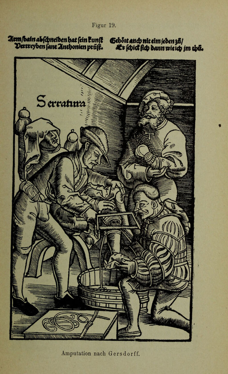 Figur 19. <*|cfcftrfi><itbat fcftt fimfj &bSttAti&nhtlmjtbm)&l TPmtcybm fant Ztufyonitn pröff. tourn im Amputation nach Gersdorff.