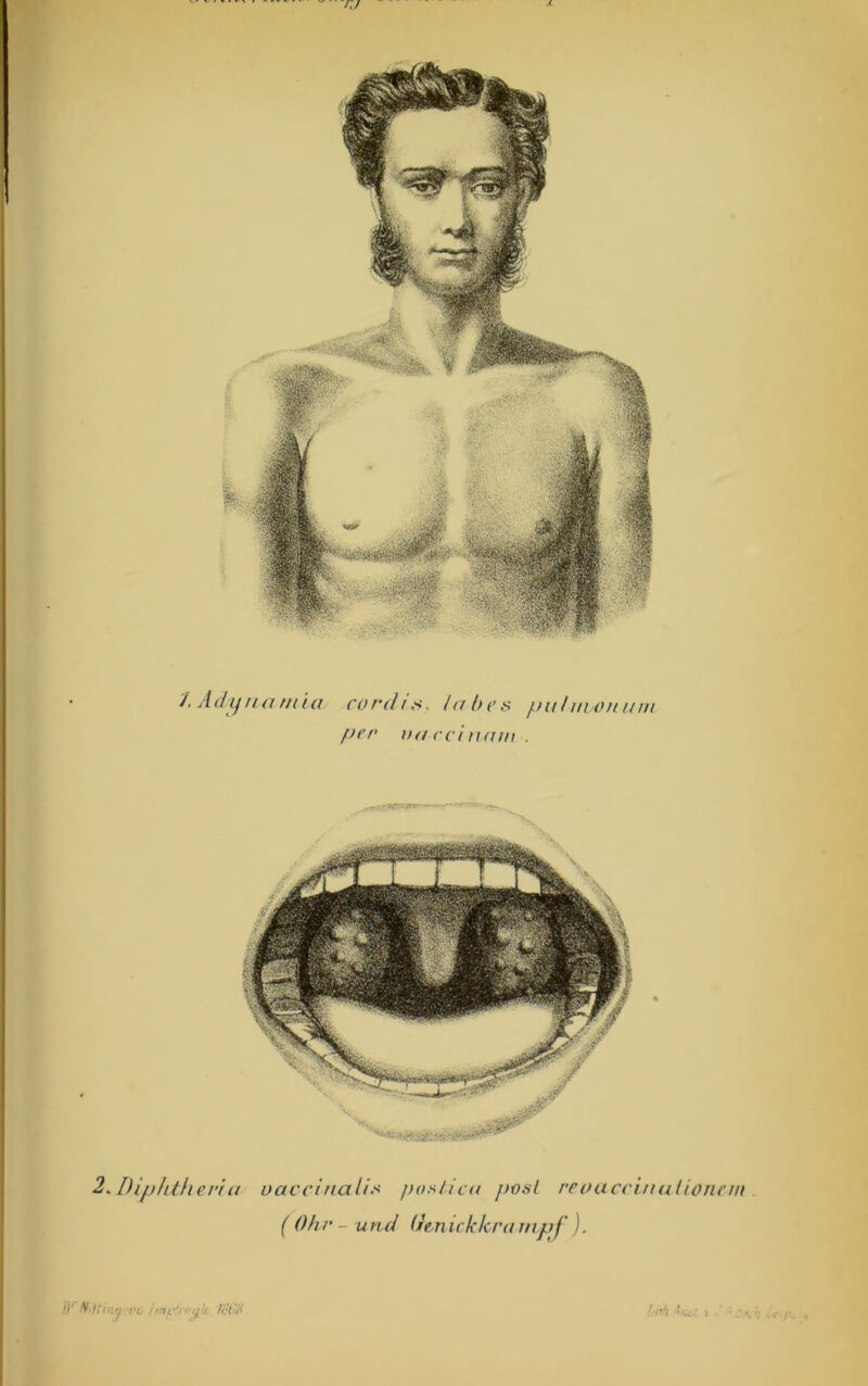 rj /. Adijnar/(((I rord/j<. iahen pulmonum per na rcinam . 2. Diphlheria oavcinalio pof^iicu ponl reoaccinalioncm . ( Oh r - u nd Ihn ick kra mpj ). »y VC hnc‘i ‘ ■'i'i- fci'AA J.pi\ | ’ ; *