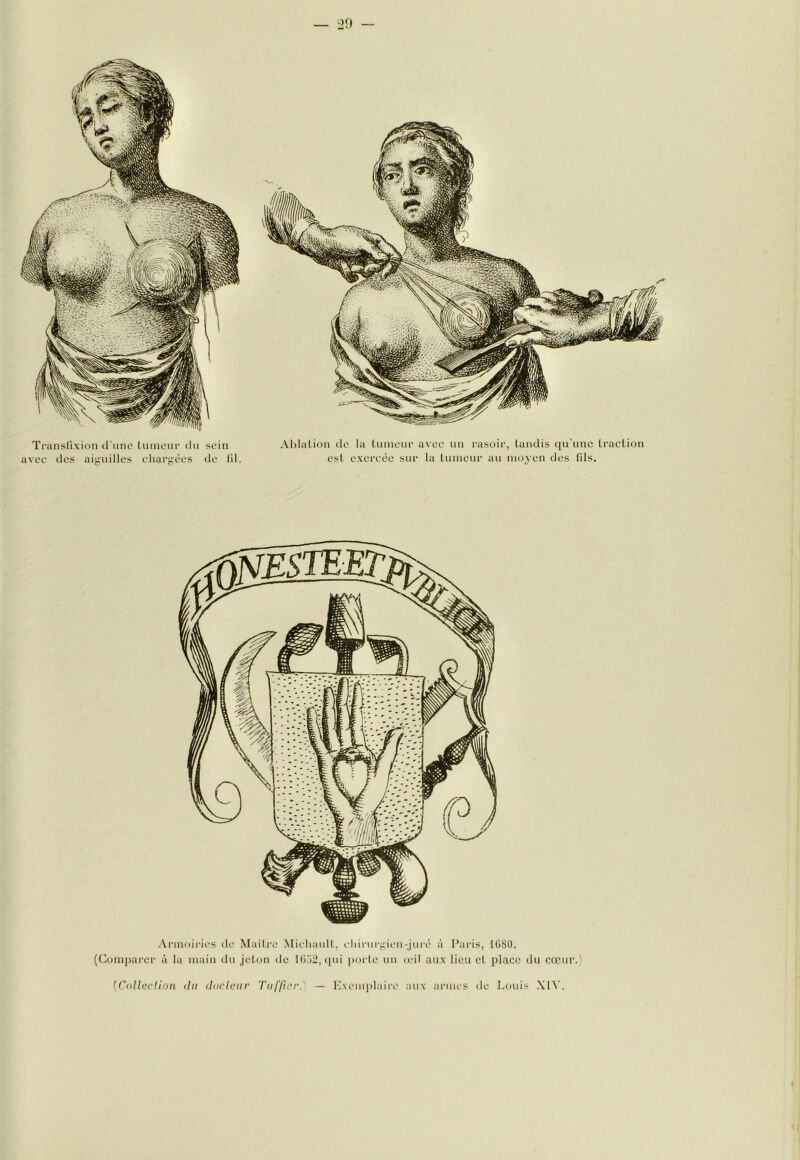 — ^2!» — Transfi\ion d une (umcur du sein avec des aifi'uilles cliarj;'ées de 111. Ablation de la Lnineui- avec un rasoir, tandis qu'une traction est exercée sur la Luineur au moyen des lils. [CoUedion du dnclcur Ttiffiord — Exemplaire aux armes île Louis Xl^^