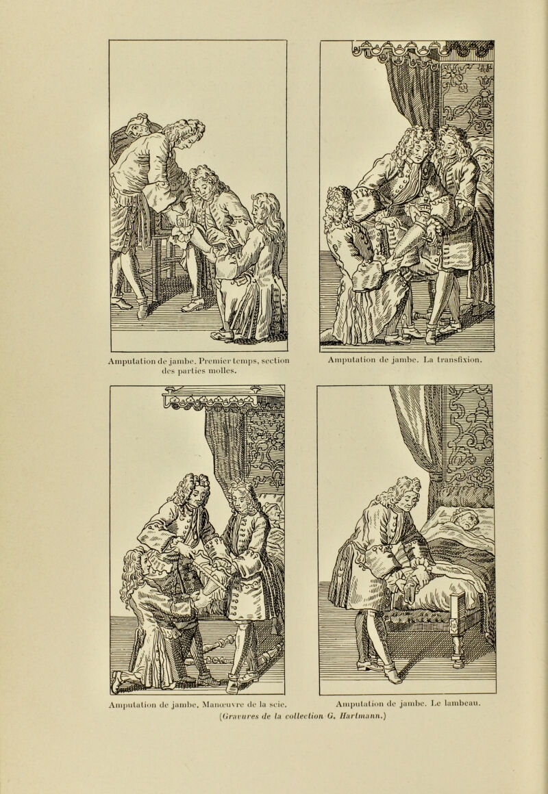 Amputation de jambe. Premier temps, section des ])arlics molles. Amputation de jambe. La transfi.xion.