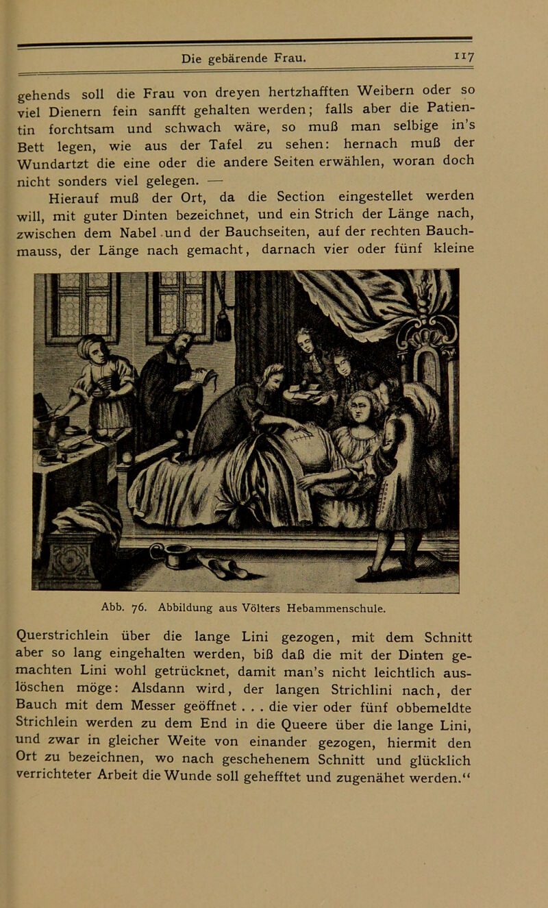 gehends soll die Frau von dreyen hertzhafften Weibern oder so viel Dienern fein sanfft gehalten werden; falls aber die Patien- tin forchtsam und schwach wäre, so muß man selbige in’s Bett legen, wie aus der Tafel zu sehen: hernach muß der Wundartzt die eine oder die andere Seiten erwählen, woran doch nicht sonders viel gelegen. — Hierauf muß der Ort, da die Section eingestellet werden will, mit guter Dinten bezeichnet, und ein Strich der Länge nach, zwischen dem Nabel .und der Bauchseiten, auf der rechten Bauch- mauss, der Länge nach gemacht, darnach vier oder fünf kleine Abb. 76. Abbildung aus Völters Hebammenschule. Querstrichlein über die lange Lini gezogen, mit dem Schnitt aber so lang eingehalten werden, biß daß die mit der Dinten ge- machten Lini wohl getrücknet, damit man’s nicht leichtlich aus- löschen möge: Alsdann wird, der langen Strichlini nach, der Bauch mit dem Messer geöffnet . . . die vier oder fünf obbemeldte Strichlein werden zu dem End in die Queere über die lange Lini, und zwar in gleicher Weite von einander gezogen, hiermit den Ort zu bezeichnen, wo nach geschehenem Schnitt und glücklich verrichteter Arbeit die Wunde soll gehefftet und zugenähet werden.“