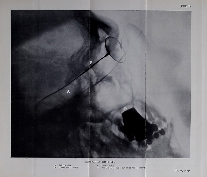SKIAGRAM OF THE SKULL. A, Sella turcica. B. Upper wall of orbit. Frontal sinus. Metal denture reaching up to roof of moutl, To face fage 15a.