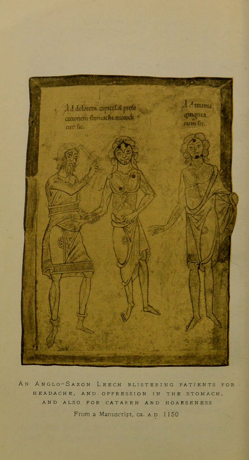 An Anglo-Saxon Leech blistering patients for HEADACHE, AND OPPRESSION IN THE STOMACH, AND ALSO FOR CATARRH AND HOARSENESS From a Manuscript, ca. a d 1150