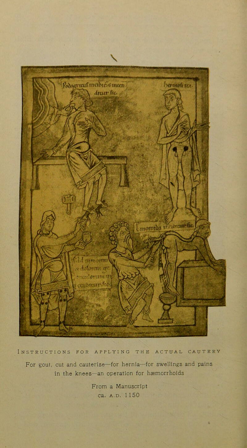 AafiMW. <T? r> i&iair-Wi 2-ns? '^'PdKi^cufmalsir-cinffij iHtik0fifa. Ajmr fic r I’HiiiortWi o. >■■- Instructions for applying the actual cautery For gout, cut and cauterise—for hernia—for swellings and pains in the knees—an operation for haemorrhoids From a Manuscript