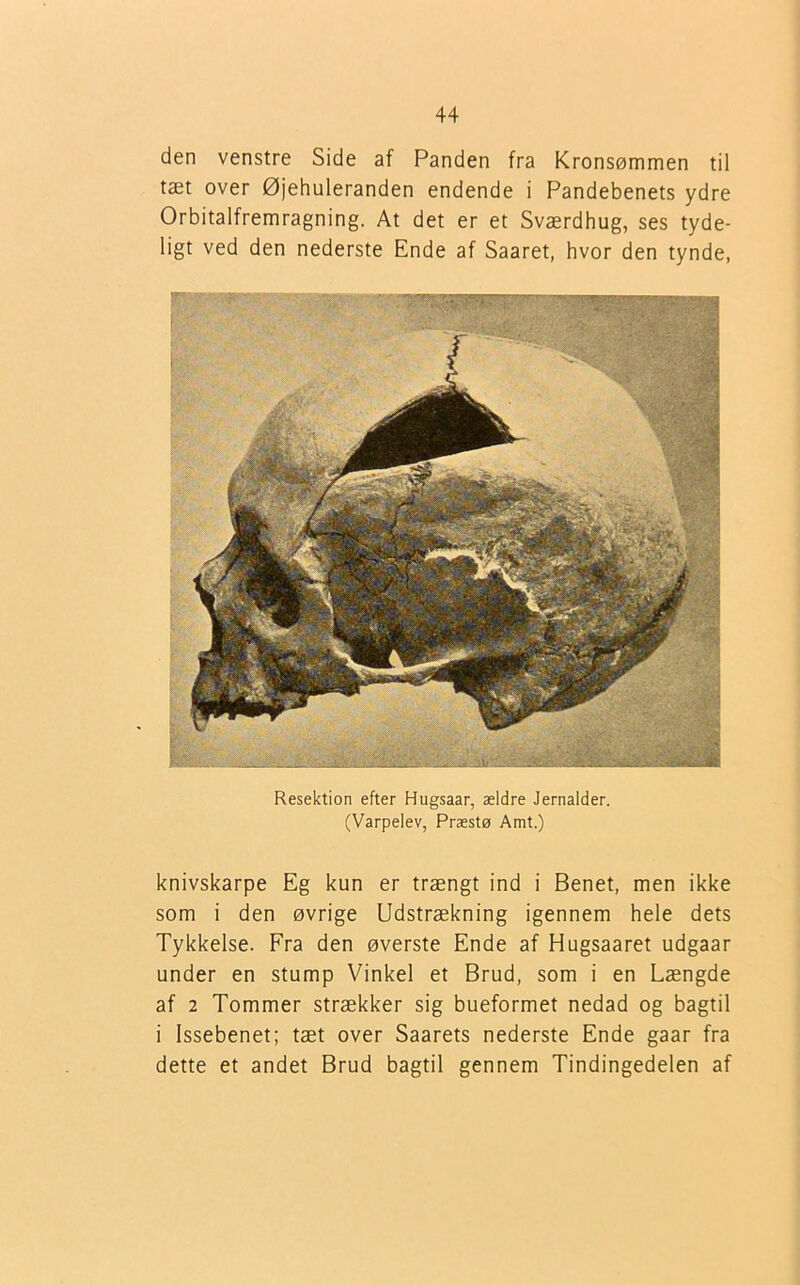 den venstre Side af Panden fra Kronsømmen til tæt over Øjehuleranden endende i Pandebenets ydre Orbitalfremragning. At det er et Sværdhug, ses tyde- ligt ved den nederste Ende af Saaret, hvor den tynde, Resektion efter Hugsaar, ældre Jernalder. (Varpelev, Præstø Amt.) knivskarpe Eg kun er trængt ind i Benet, men ikke som i den øvrige Udstrækning igennem hele dets Tykkelse. Fra den øverste Ende af Hugsaaret udgaar under en stump Vinkel et Brud, som i en Længde af 2 Tommer strækker sig bueformet nedad og bagtil i Issebenet; tæt over Saarets nederste Ende gaar fra dette et andet Brud bagtil gennem Tindingedelen af