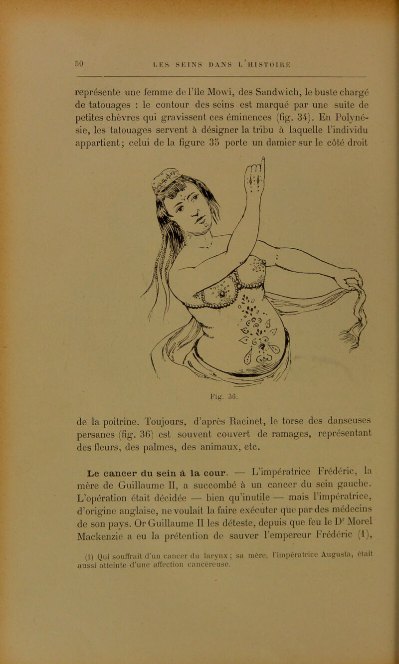 représente une femme del’île Mowi, des Sandwich, le buste chargé de tatouages : le contour des seins est marqué par une suite de petites chèvres qui gravissent ces éminences (fig. 34). En Polyné- sie, les tatouages servent à désigner la tribu à laquelle l’individu appartient; celui delà figure 33 porte un damier sur le côté droit de la poitrine. Toujours, d’après Racinet, le torse des danseuses persanes (fig. 3G) est souvent couvert de ramages, représentant des fleurs, des palmes, des animaux, etc. Le cancer du sein à, la cour. — L impératrice Frédéric, la mère de Guillaume II, a succombé à un cancer du sein gauche. L’opération était décidée — bien qu’inutile — mais l'impératrice, d’origine anglaise, ne voulait la faire exécuter que par des médecins de son pays. Or Guillaume II les déteste, depuis que leu le Dr Morel Mackenzie a eu la prétention de sauver l’empereur Frédéric (1), (1) Qui souffrait d'un cancer du larynx; sa mûre, l'impératrice Augusta, était aussi atteinte d'une affection cancéreuse.