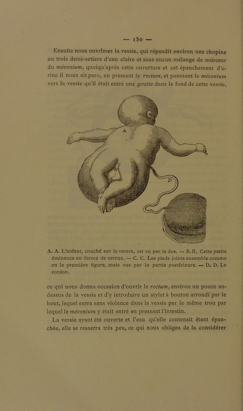 Ensuite nous ouvrîmes la vessie, qui répandit environ une chopine ou trois demi-setiers d’eau claire et sans aucun mélange de noirceur du méconium, quoiqu’après cette ouverture et cet épanchement d’u- rine il nous ait paru, en pressant le rectum, et poussant le méconium vers la vessie qu’il était entré une goutte dans le fond de cette vessie, A. A. L’enfant, couché sur le ventre, est vu par le dos. — B. B. Cette petite éminence en forme de verrue. — C. C. Les pieds joints ensemble comme en la première figure, mais vus par la partie postérieure. — D. D. Le cordon. ce qui nous donna occasion d’ouvrir le rectum, environ un pouce au- dessus de la vessie et d’y introduire un stylet à bouton arrondi par le bout, lequel entra sans violence dans la vessie par le même trou par lequel le méconium y était entré en pressant l’intestin. La vessie ayant été ouverte et l’eau qu’elle contenait étant épan- chée, elle se resserra très peu, ce qui nous obligea de la considérer