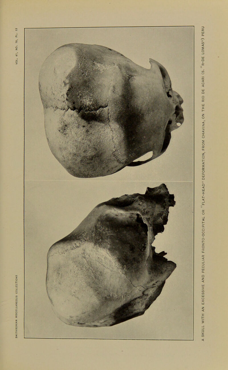 A SKULL WITH AN EXCESSIVE AND PECULIAR FfiONTO-OCCIPITAL OR “pLAT-HEAD” DEFORMATION, FROM CHAVINA,ON THE RIO DE ACARI (S. “r-DE LOMAS”) PERU