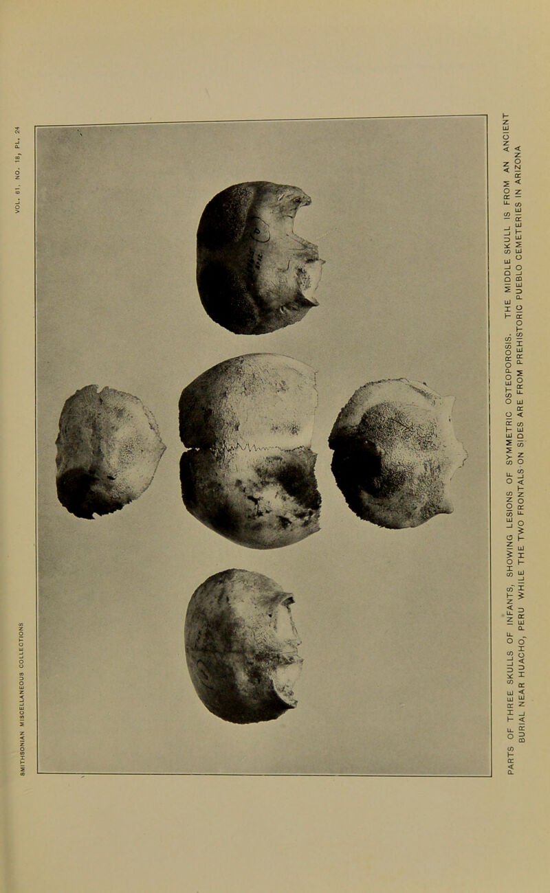 8MITHS0NJAN MISCELLANEOUS COLLECTIONS PARTS OF THREE SKULLS OF INFANTS, SHOWING LESIONS OF SYMMETRIC OSTEOPOROSIS. THE MIDDLE SKULL IS FROM AN ANCIENT BURIAL NEAR HUACHO, PERU WHILE THE TWO FRONTALS ON SIDES ARE FROM PREHISTORIC PUEBLO CEMETERIES IN ARIZONA