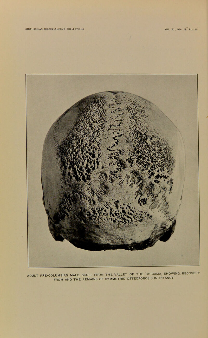 ADULT PRE-COLUMBIAN MALE SKULL FROM THE VALLEY OF THE CHICAMA, SHOWING: RECOVERY FROM AND THE REMAINS OF SYMMETRIC OSTEOPOROSIS IN INFANCY