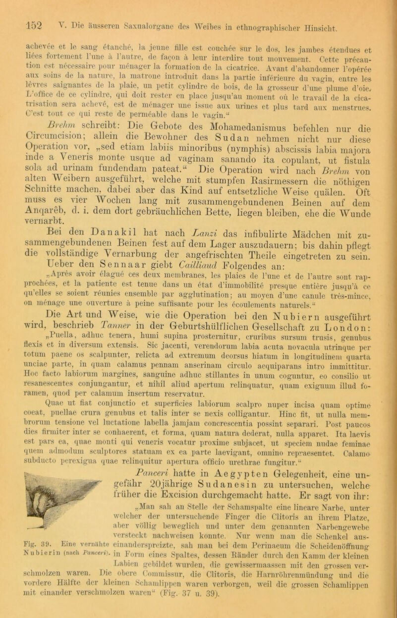 achevee et le sang etanche, la jeune iille est couchSe sur le dos, les jambes etendues et licts foiteinent 1 une a i autie, de fa^on a leur interdire tout mouvement. Cette precau- ti°n est necessaire pour menager la formation de la cicatrice. Avant d’abandonner l’operee aux soins. de la nature, la matrone introduit dans la partie inferieure du vagin, entre les levres saignantes de la plaie, un petit cylindre de bois, de la grossem- d’une pl’ume d'oie, L’offiee de ce cylindre, qui doit rester en place jusqu’au moment oü le travail de la cica- trisation sera acheve, est de menager une issue aux urines et plus tard aux menstrues. C’est tout ce qui reste de permeable dans le vagin.“ Brehm schreibt: Die Gebote des Mohamedanismus befehlen nur die Cii cumcision, allein die Bewohner des Sudan nehmen nicht nur diese Opeiation xor, „sed etiam labiis minoribus (nympbis) abscissis iabia majora inde a Veneris monte usque ad vaginam sanando ita copulant, ut fistula sola ad urinam tundendam pateat.“ Die Operation wird nach Brehm von alten Weibern ausgeführt, welche mit stumpfen Rasirmessern die nöthigen Schnitte machen, dabei aber das Kind auf entsetzliche Weise quälen. Oft muss es vier Wochen lang mit zusammengebundenen Beinen auf dem Anqareb, d. i. dem dort gebräuchlichen Bette, liegen bleiben, ehe die Wunde vernarbt. Bei den Danakil hat nach Panzi das infibulirte Mädchen mit zu- sammengebundenen Beinen fest auf dem Lager auszudauern; bis dahin pflegt die x ollständige V ernarbung der angefrischten Theile eingetreten zu sein. Ueber den Sennaar giebt Cailliaud Folgendes an: „Apres avoir elague ces deux membranes, les plaies de l:une et de Pautre sont rap- prochees, et la patiente est tenue (laus un etat d immobilite presque entiere jusqu’ä ce qu eiles se soient leunies ensemble par agglutination; au mo37en d’une canule tres-mince. on menage une ouverture ä peine süffisante pour les ecoulements naturels.“ Die Art und Weise, wie die Operation bei den Nubiern ausgeführt wild, beschrieb Banner in der Geburtshüll liehen Gesellschaft zu London: „I uella, adhuc tenera, humi supina prosternitur, cruribus sursum trusis, genubus- flexis et in diversum extensis. Sic jacenti, verendorum labia acuta novacula utrinque per totum paene os scalpunter, relicta ad extremum deorsus hiatum in longitudinem quarta unciae parte, in quam calamus pennam anserinam circulo aequiparans intro immittitur. Hoc facto labiorum margines, sanguine adhuc stillantes in unum coguntur, eo consilio ut resanescentes conjungantur, et nihil aliud apertum relinquatur, quam exiguum illud fo- ramen, quod per calamum insertum reservatur. Quae ut fiat conjunctio et superficies labiorum scalpro nuper incisa quam optime- coeat, puellae crura genubus et talis inter se nexis colligantur. Hinc fit, ut nulla mem- brorum tensione vel luctatione labella jamjam concrescentia possint separari. Post paucos die» firmiter inter se conhaerent, et forma, quam natura dederat, nulla apparet. Ita laevis est pars ea, (iuae monti qui veneris vocatur proxime subjacet, ut speciem nudae feminae quem admodum sculptores statuam ex ea parte laevigant, omnino repraesentet. Calamo subducto perexigua quae relinquitur apertura officio urethrae fungitur.“ Pcinceri hatte in Aegypten Gelegenheit, eine un- gefähr 20jährige Sudanesin zu untersuchen, welche früher die Excision durchgemacht hatte. Er sagt von ihr: „Man sah an Stelle der Schamspalte eine lineare Narbe, unter welcher der untersuchende Finger die Clitoris an ihrem Platze, aber völlig beweglich und unter dem genannten Narbengewebe versteckt nachweisen konnte. Nur wenn man die Schenkel aus- Fig. 39. Fine vernähte einanderspreizte, sah man bei dem Perinaeum die Scheidenöffnung Nubierin (nach Panceri). in Form eines Spaltes, dessen Ränder durch den Kamm der kleinen Labien gebildet wurden, die gewissermaassen mit den grossen ver- schmolzen waren. Die obere Commissur, die Clitoris, die Harnröhrenmündung und die vordere Hälfte der kleinen Schamlippen waren verborgen, weil die grossen Schamlippen mit einander verschmolzen waren“ (Fig. 37 u. 39).