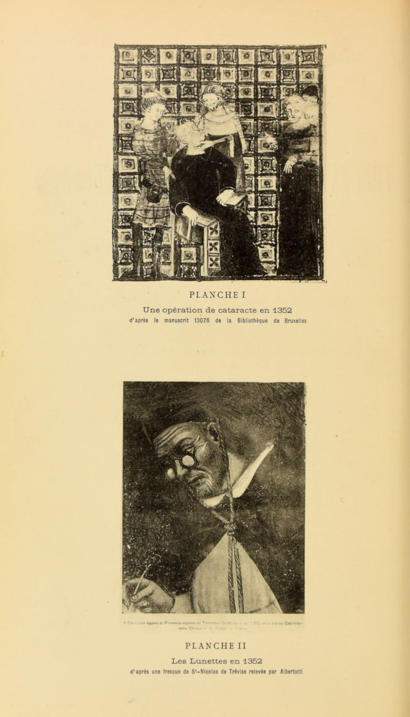 PLANCHEI Une op6ration de cataracte en 1352 d'apres le manuscrit 13076 de Ia Bibliotheque de Bruxelles • I C«' • *'* Upont d P'Ov#n/a d>p»oto da Tm - • «**Ma ’ • i' i» Cmc PLANCHE II Les Lunettes en 1352 d'aprds une fresque de S<-Nicolas de Trdvise relevde par Albertotti