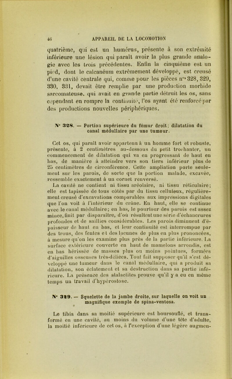 quatrième, qui est un humérus, présente à son extrémité inférieure une lésion qui paraît avoir la plus grande analo- gie avec les trois précédentes. Enfin la cinquième est un pied, dont le calcanéum extrêmement développé, est creusé d’une cavité centrale qui, comme pour les pièces nu,328, 329, 330, 331, devait être remplie par une production morbide sarcomateuse, qui avait en grande partie détruit les os, sans cependant en rompre la continuité, l’os ayant été renforcé par des productions nouvelles périphériques. X* 338. — Portion supérieure du fémur droit; dilatation du canal médullaire par une tumeur. Cet os, qui paraît avoir appartenu à un homme fort et robuste, présente, à 2 centimètres au-dessous du petit trochanter, un commencement de dilatation qui va en progressant de haut en bas, de manière à atteindre vers son tiers inférieur plus de 25 centimètres de circonférence. Cette ampliation porte seule- ment sur les parois, de sorte que la portion malade, excavée, ressemble exactement à un cornet renversé. La cavité ne contient ni tissu aréolaire, ni tissu réticulaire; elle est tapissée de tous côtés par du tissu celluleux, régulière- ment creusé d’excavations comparables aux impressions digitales que l’on voit à l’intérieur du crâne. En haut, elle se continue avec le canal médullaire; en bas, le pourtour des parois est assez mince, finit par disparaître, d’où résultent une série d'échancrures profondes et de saillies considérables. Les parois diminuent d’é- paisseur de haut en bas, et leur continuité est interrompue par des trous, des fentes et des lacunes de plus en plus prononcées, à mesure qu’on les examine plus près de la partie inférieure. La surface extérieure couverte en haut de mamelons arrondis, est en bas hérissée de masses plus ou moins pointues, formées d’aiguilles osseuses très-déliées. Tout fait supposer qu’il s’est dé- veloppé une tumeur dans le canal médullaire, qui a produit sa dilatation, son éclatement et sa destruction dans sa partie infé- rieure. La présence des stalactites prouve qu’il y a eu en même temps un travail d’hypérostose. IM* 3*9. — Squelette de la jambe droite, sur laquelle on voit un magnifique exemple de spina-ventosa. Le tibia dans sa moitié supérieure est boursouflé, et trans- formé en une cavité, au moins du volume d’une tète d’adulte, la moitié inférieure de cet os, à l’exception d’une légère augmen-