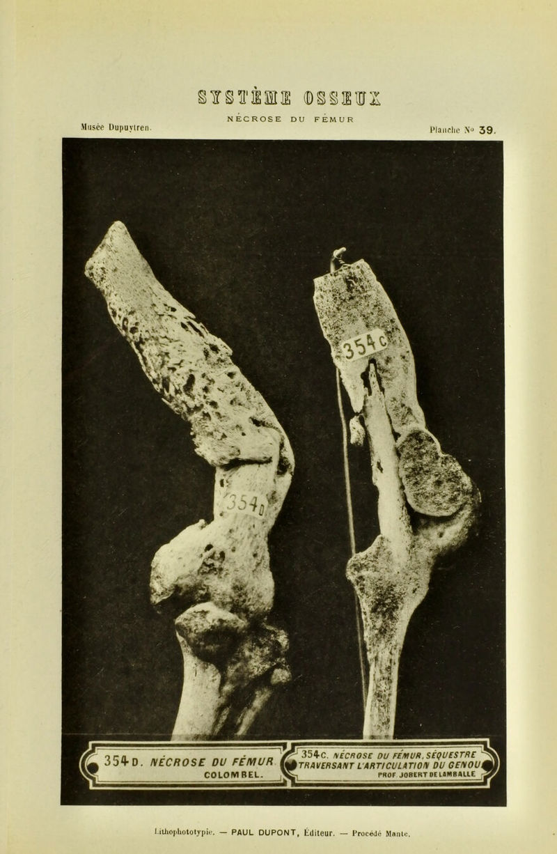 Musée Dupuviren. Planche N° 39. TSÏ'SfflB (DS g B12 NECROSE DU FEMUR l.itiiojiUototypie. — PAUL DUPONT, Éditeur. Procédé Mante.