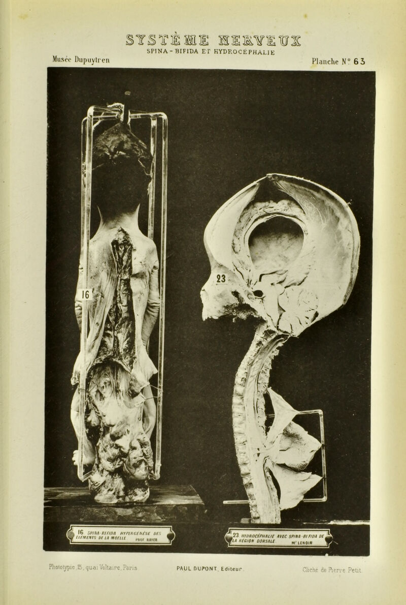 Musée Dupuyiren SPINA-BIFIDA ET HYDROCEPHALIE Flanche N“ 65 oÛê' SHM K/r/pA iD ùK/ï/i Kir/PA nrrcPGfAfsc pip urNicnj’i 01 LA monii »23 HtPPOCiPHAlir AVIC SPIPA PLFIDA P[ LA HteiON OOPSALC „„qi. l'iior KtrtR