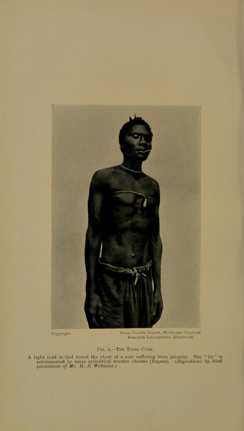 Copyright From Fourth Report. Wellcome Tropical Research Laboratories, Khartoum Fig. 1.—Tim Tying Curb. A tight cord is tied round the chest of a man suffering from pleurisy. The “tie'’ is accompanied by some cylindrical wooden charms (Bagara). (Reproduced by kind