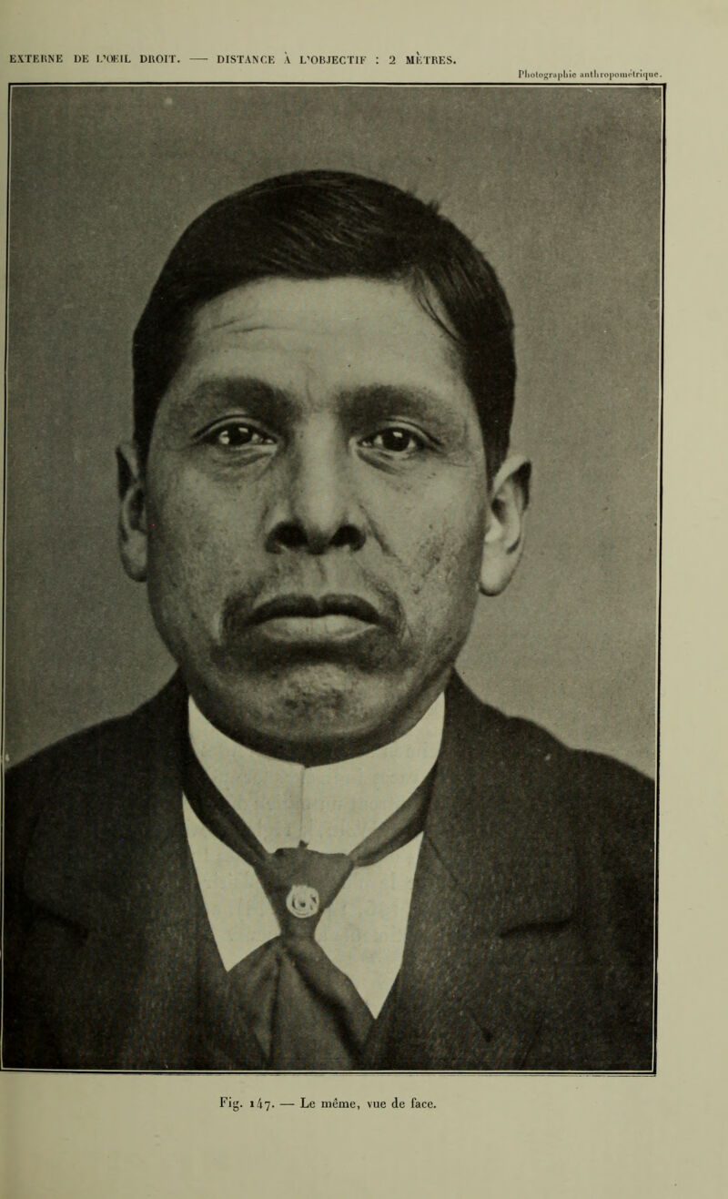 EXTEHNE DE l.’OEIL DROIT DISTANCE A L’OBJECTIE 2 METRES. Pliotograpliic antliro|)oim-tr!ï]ue. Fig. 1/17. — Le même, vue de face.