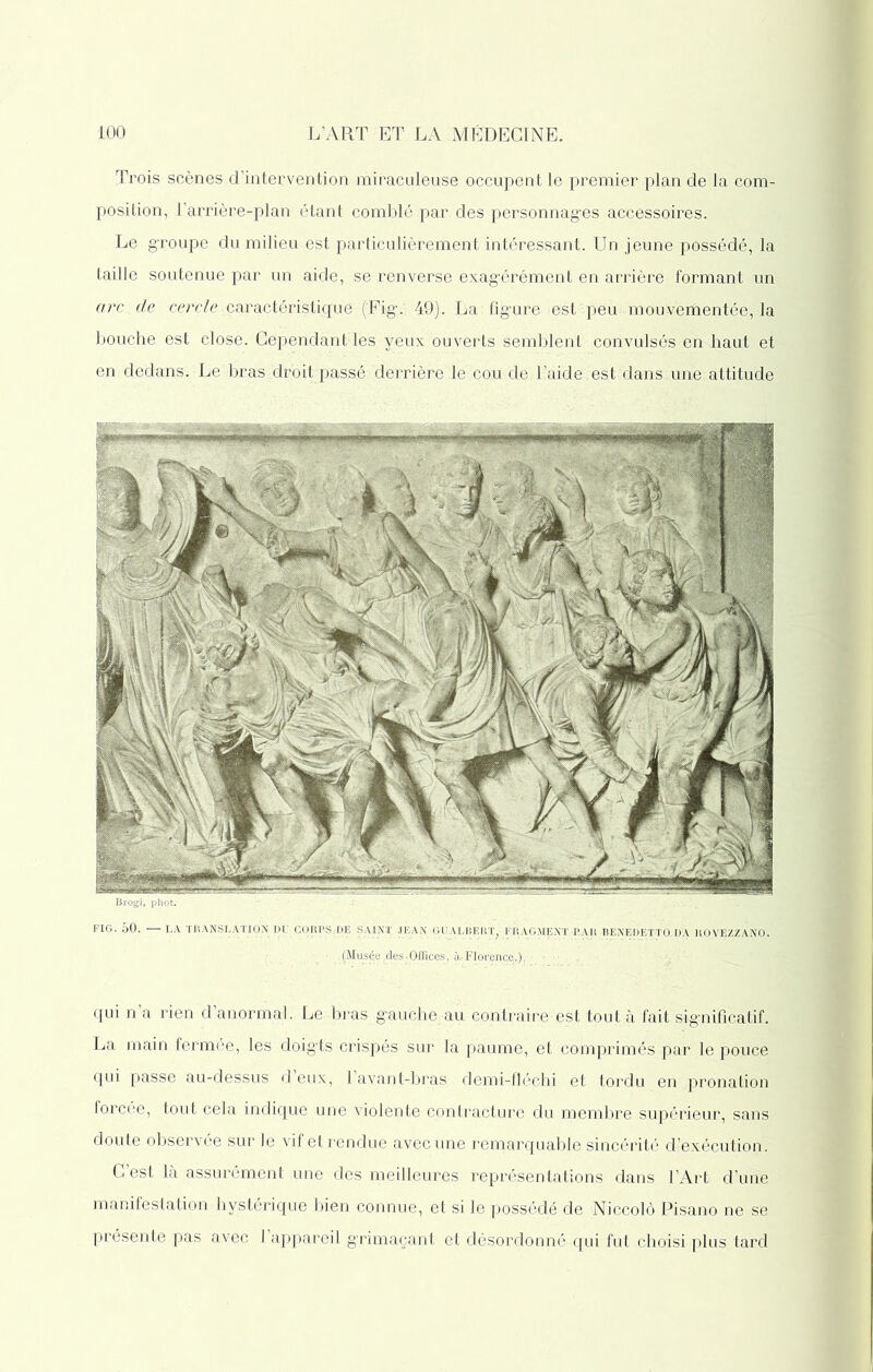 Trois scènes d’intervention miraculeuse occupent le premier plan de la com- position, l’arrière-plan étant comblé par des personnages accessoires. Le groupe du milieu est particulièrement intéressant. Un jeune possédé, la taille soutenue par un aide, se renverse exagérément en arrière formant un arc de cercle caractéristique (Fig’. 49). La figure est'peu mouvementée, la bouche est close. Cependant les yeux ouverts semblent convulsés en haut et en dedans. Le bras droit passé derrière le cou de l’aide est dans une attitude Brogi, plie:. FIG. 50. —• LA. TRANSLATION DU COBPS DE SAINT JEAN GIÏALBERT, FRAGMENT PAR BENEDETTO.DA HOVEZZANO. (Musée(des.Offices, iuFlorence.), qui n’a rien d’anormal. Le bras gauche au contraire est tout à fait significatif. La main fermée, les doigts crispés sur la paume, et comprimés par le pouce qui passe au-dessus d eux, l’avant-bras demi-fléchi et tordu en pronation forcée, tout cela indique une violente contracture du membre supérieur, sans doute observée sur le vif et rendue avec une remarquable sincérité d’exécution. C est là assurément une des meilleures représentations dans l’Art d’une manifestation hystérique bien connue, et si le possédé de Niccolô Pisano ne se présente pas avec l’appareil grimaçant et désordonné qui fut choisi plus tard