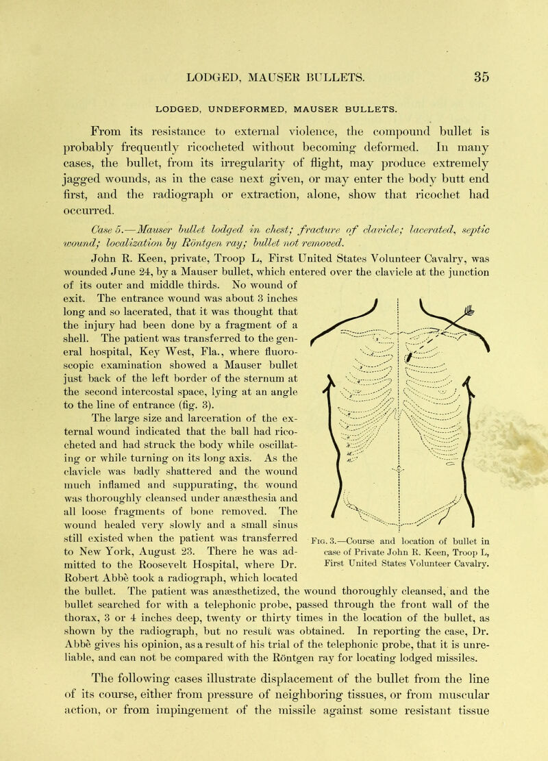LODGED, UNDEFORMED, MAUSER BULLETS. From its resistance to external violence, the compound bullet is probably frequently ricocheted without becoming’ deformed. In many cases, the bullet, from its irregularity of flight, may produce extremely jagged wounds, as in the case next given, or may enter the body butt end first, and the radiograph or extraction, alone, show that ricochet had occurred. Cane 5.—Mauser Imllet lodged in chest; fracture of clavicle; lacerated^ septic wound; localization hy Rontgen ray; hullet not removed. John R. Keen, private, Troop L, First United States Volunteer Cavalry, was wounded June 24, by a Mauser bullet, which entered over the clavicle at the junction of its outer and middle thirds. No wound of exit. The entrance wound was about 3 inches long and so lacerated, that it was thought that the injury had been done by a fragment of a shell. The patient was transferred to the gen- eral hospital. Key West, Fla., where fluoro- scopic examination showed a Mauser bullet just back of the left border of the sternum at the second intercostal space, lying at an angle to the line of entrance (flg. 3). The large size and lai’ceration of the ex- ternal wound indicated that the ball had rico- cheted and had struck the body while oscillat- ing or while turning on its long axis. As the clavicle was badly shattei’ed and the wound much inflamed and suppurating, the wound was thoroughly cleansed under antesthesia and all loose fragments of bone removed. The wound healed very slowly and a small sinus still existed when the patient was transferred pjQ 3_—Course and location of bullet in to New York, August 23. There he was ad- case of Private John R. Keen, Troop L, mitted to the Roosevelt Hospital, where Dr. First United States Volunteer Cavalry. Robert Abbe took a radiograph, which located the bullet. The patient was anaesthetized, the wound thoroughly cleansed, and the bullet searched for with a telephonic probe, passed through the front wall of the thorax, 3 or 4 inches deep, twenty or thirty times in the location of the bullet, as shown by the radiograph, but no result was obtained. In reporting the case. Dr. Abbe gives his opinion, as a result of his trial of the telephonic probe, that it is unre- liable, and can not be compared with the Rontgen ray for locating lodged missiles. The following cases illustrate displacement of the bullet from the line of its course, either from pressure of neighboring tissues, or from muscular action, or from impingement of the missile against some resistant tissue