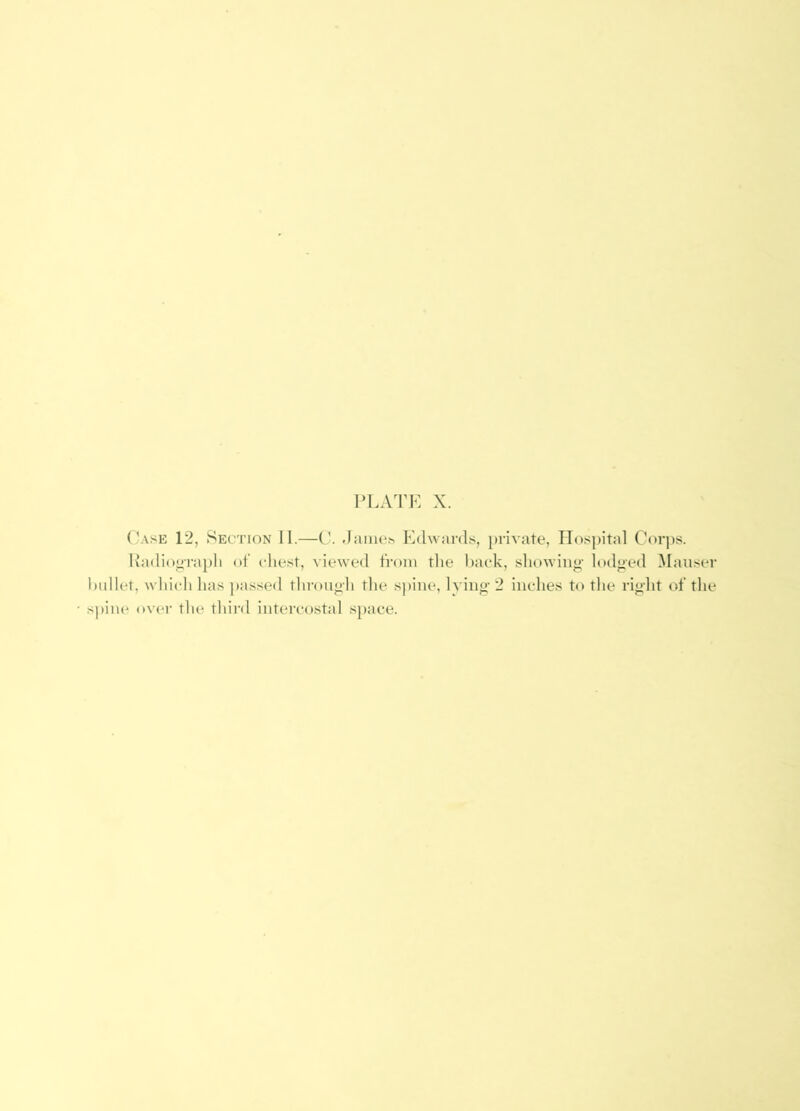 (’ase 12, Section II.—Jainc^ Edwards, private. Hospital Corps. Kadioorapli of cdiest, viewed from the Iiaek, showing- lodj^ed Manser l)iillet, whitdi has jiassed through the spine, Iving’ 2 inches to the right of the s))iiu* ov(*r the third intercostal space.