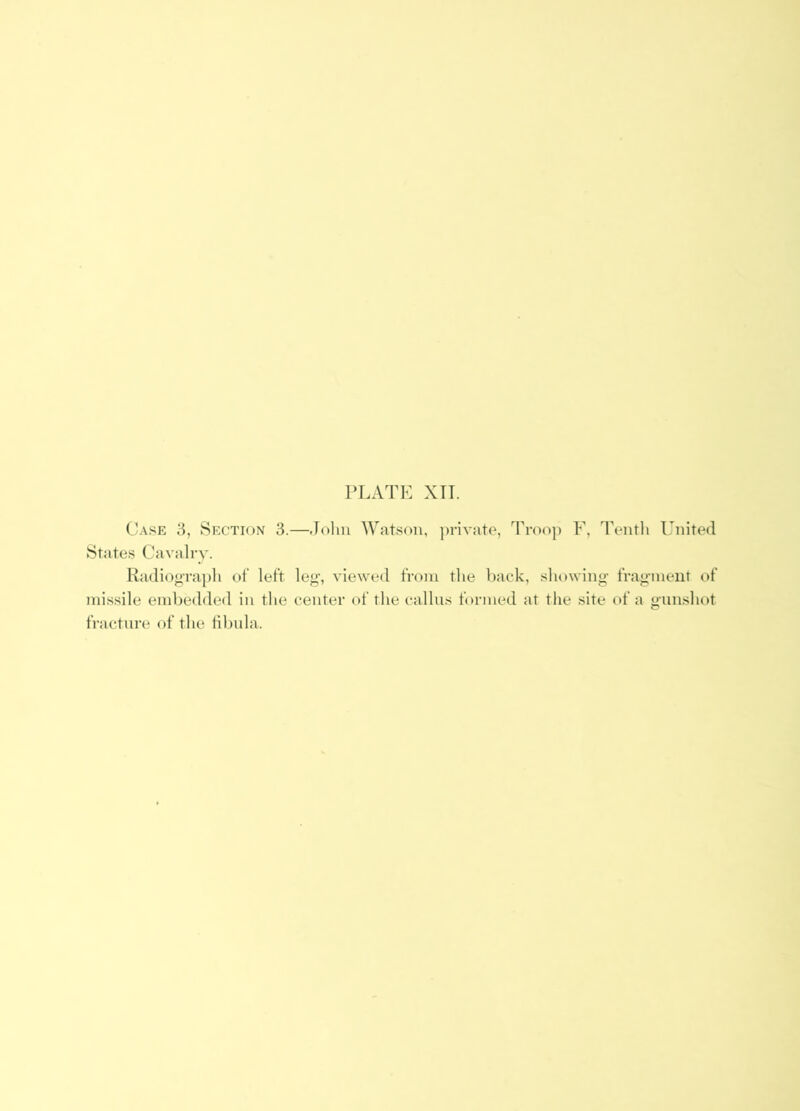 Case 8, Section 3.—John Watson, ])nvate, Troop F, Tentli United States Cavalry. Radiograpli of left le”', viewed from the back, showing frag’ineut of missile embedded in the center of the callus formed at tlie site of a gunshot fracture of the tibula.