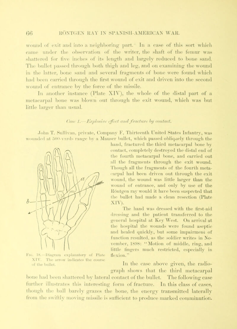 wnimd ot' <*xit and into a mno-liljoi-iii}.'- pai't. In a ca.'^e of this soi*t which cainc niidcr the ohsei'vation of the wi-iter, the sliaft of the feinni' was shattered foi' live iindies of its leiiii’th and laro'elv reclnced to hone sand, d'he hnllet passed thi'onj^h both tlii^li and lef>’, and on exainininjr the wound in tin* lattei-, l)one sand and several fra^finents of hone were found which had heen carricfl tlii'on^h the iirst wound of exit and driven into the second wound of entrance hy the force of the missile. In anothei- instance (Plate XI\ ), tlu* whole of the distal part of a metacai])al hoim was blown ont tln-onj>'h the exit wound, which was hut little larj^-ei- than usnal. (/. — ICi'jilnulrr nn<l flutetui'i! hij rtmtnrt. •lolni T. Sullivan, private*, ('oinpaiiy F, TliirU'enth Pnited States Infantry, was wouii(lt‘<l at aoo-vinh ranye* l»y a .Mau.'icr hnllet, which passed ohlicjaelv thronyli the hand, fractured the third metacarpal lK)iie hv contact, completely de.stroyed the distal end of tin* fourth metacarpal hone, atid carried out all the fragments throuyh tlie exit wound, 'fhonyh all the fragments of the fourth meta- carpal had bee'll driven out throuejh the exit wound, the wound was little larger than the wound of entrance, and only hy u.se of the Riintgen ray would it have heen susjiOcteHl that (he* hnllet had made a clean re.section (Plate XIV). The hanel was dres.sed with the tirst-aid elre'ssiug and the patient transferivd to the ge'ueral hospital at Key We.st. On arrival at the* hospital the wounds were found a.soj)tic and healed (piickly, hut .some impaiimem of function resulted, as the .•soldier writes in No- vemher, IS'.tS: ** Motion of middle, ring, and little ling(*rs much restricted, especially in Kiu. IS.—l)iaj;ram rxplaiiatory of Plan* llcxion.” XIV. Till* arrow imlicalc.'i tlic com-?'c of itu-iiiiilct. Pi tin* case above given, the radio- graph shows that tin* third metacarpal bone had b(*en shattered bv lateral contact of the bullet. The following case Inrthei* illustrates this inten'sting form of fracture*. In this class of cases, though the ball baivly grazes the bone, the energy transmitted laterally trom the swiftly mo\ ing missile is sullicient to jirodui’e marked comminution.