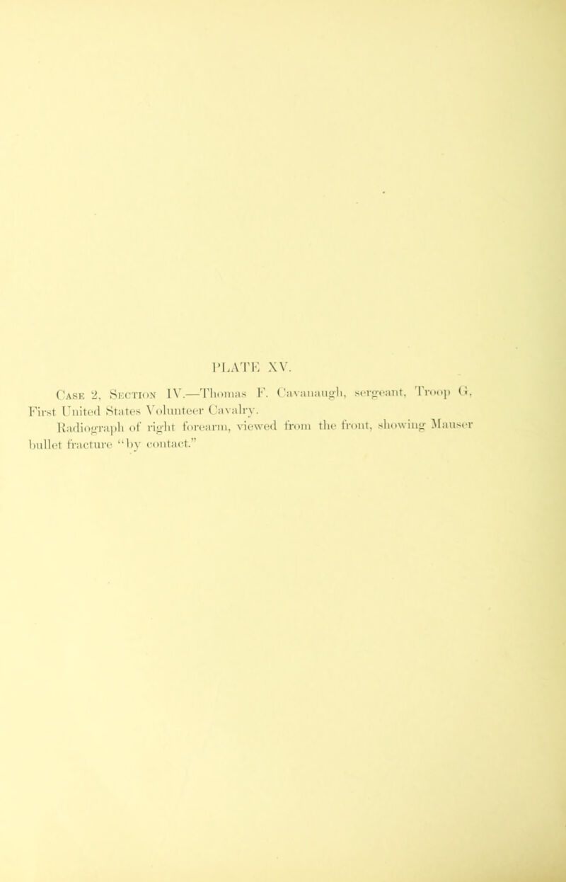 Vl.ATV: XV. C'ase 2, Section IV.—Thomas F. Cavanauoh, sor^mant, Troop (i, First Fiiited States \'oluiiteer Cavalry. l\a(lio”Tai)h of ri^-lit forearm, viewed from the front, .sliowiiig- Maus(*r hullet fracture “hy contact.”