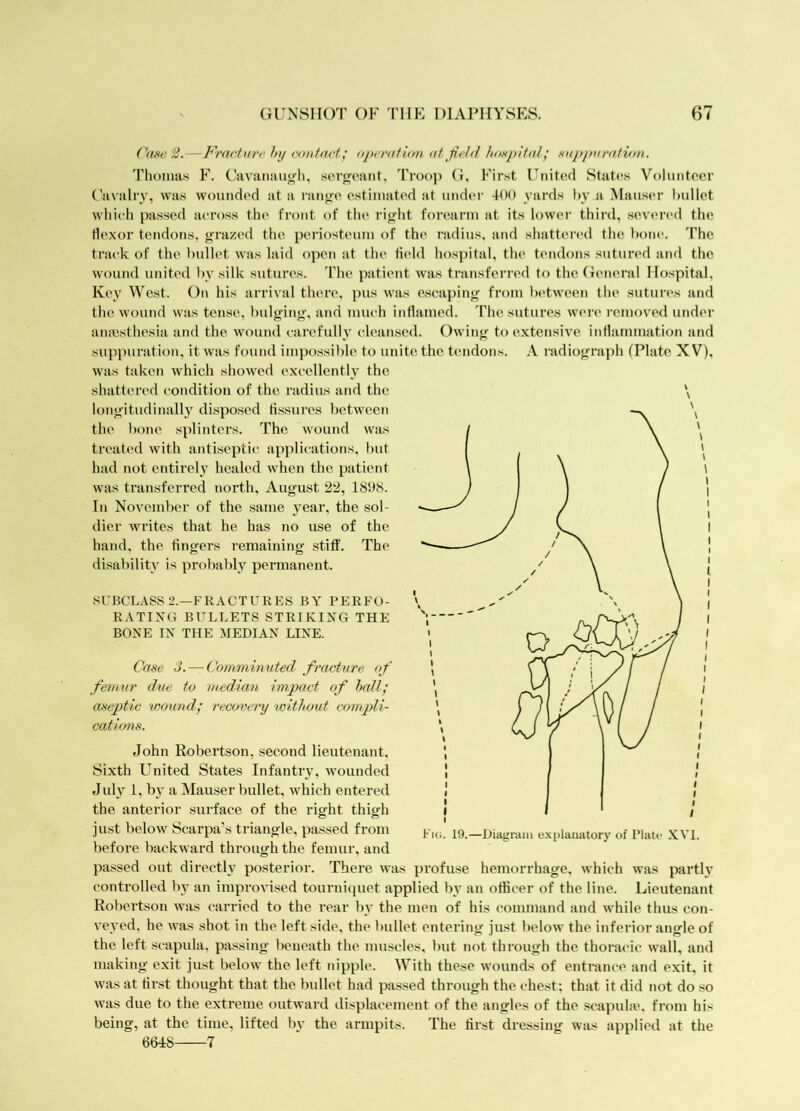 (JUNSIIOT OF TIIF DIAl’IIYSES. 67 (}mt 3.—Frar.ture hij contact; opcratitm at field laisj>ltalf xupparatinn. Tlioniiis F. Cavaimuifh, serjjoant, 'i'roop (i. First United State's Volunteer Uavalrv, was wounded at a ranfje estimated at under 400 yards hy a Mauser bullet which passed across the front of the riffht forearm at its lower third, sevi'red the Hexor tendons, grazed the periosteum of the radius, and shattenal the boiu'. The track of the bullet was laid open at the field hospital, the tendons sutured and the wound united by silk sutures. 'Phe patient was transferred to the (ieneral Hospital, Key West. On his arrival there, pus was e.seaping from between the .sutures and the wound was tense, bulging, and much inflamed. The sutures were removed under amesthesia and the wound carefully cleansed. Owing to extensive inflammation and suppuration, it was found impossible to unite the tendons. A I'adiograph (Plate XV), was taken which showed excellently the shattered condition of the radius and the \ longitudinalh disposed fissures between the bone splinters. The wound was treat('d with antiseptic applications, f)ut had not entireh healed when the patient was transferred noidh, August 22, IShfS. In November of the same year, the sol- dier writes that he has no use of the hand, the fingers remaining stiff. The disability i>^ probably permanent. SUBCLASS 2.—FRACTURES BY PERFO- RATING BULLETS STRIKING THE BONE IN THE MEDIAN LINE. Case S. — Comminuted fracture of femur due to median impact of hail; aseptic vmmd; recovei'y without compli- catdms. John Robertson, second lieutenant. Sixth United States Infantry, wounded Jid\ 1, by a Mauser bullet, which entered the anterior sm-face of the right thigh just below Scarpa’s triangle, passed from before backward through the femur, and passed out directly posterior. There was profuse hemorrhage, which was partly controlled by an improvised tournitpiet applied by an officer of the line. Lieutenant Robertson was carried to the rear by the men of his command and while thus con- veyed. he was shot in the left side, the bullet entering just below the inferior angle of the left scapula, passing beneath the muscles, but not through the thoracic wall, and making exit just below the left nipple. With these wounds of entrance and exit, it was at first thought that the bullet had passed through the chest; that it did not do so was due to the extreme outward displacement of the angles of the scapuhe, from his being, at the time, lifted by the armpits. The first dressing was applied at the