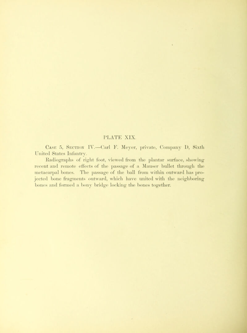 ri.ATK XIX. Case 5, Section IV.—Carl F. Moyer, ])rivate, Company D, Sixth Cnited States Infantry. Hadiog-raphs of riglit foot, viewed from the plantar surface, showing: recent and remote effects of the })assage of a Mauser bullet throug:h the metaear])al l)ones. The j)assa<^e of the hall from within outward has pro- jected hone frag'inents outwai'd, which liave united with the neig'hhoring: hones and forme<l a l)onv hridm* locking the hones tou'ether.