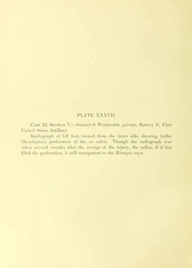 Case 12, Section \'.—Samuel S. Wentworth, private, Battery K, First United States Artillery. !\adio<iTa])li of left foot, viewed from the inner side, showin«r l)idlet (Remington) ])erfoi'ation of the os ealcis. Though the radiograph was taken several months after the receipt of the injury, the callus, if it has lilled the perforation, is still transparent to the Hiintgen ravs.