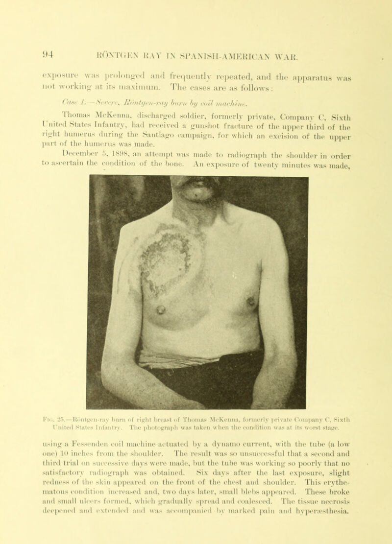 • •xposiirf was |»r<.l.iii<ic«l aixl fn-(|U('iiTly repeated, and tlx- appanitus was not woi-kinji' at its maxininm. d'lx' cases are as follows; ( UMf J. .S/'/V/V . hurn hi/ roil iiitir/i!Ill . I lioiims McKenna, discharjj’cd soldier, fonnerlv i)rivate. ('onipanv Sixth I inted States Infantry, had reeeivtal a jrunshot fracture of the upper third of the rijrht hnineriis dnriiij; the Saiitia«ro eampaie-n. for which an excision of the upiwr l>art of the hinnerus was made. December .t. ISKS. an attempt was made to radioc'raph tlx* shoulder iii order to asc(>rtain the condition of the bone. An exposure of twenty mitmtes was made. I'm. 2-1.—Itrnitp-n-iiiy lnirn <>f rinlif breast nf Tliomas MeKeiuia, litrnierly |irivate ('tiiii|iany t', .sixllt I'nile<l Slates Infantry. The plmto^rapli was take?i wlu>n the i-oinlition was at its witi>t sla^e. usin«,r it Fe.ssenden coil inix hine m-tuated liy a dynamo cum'ut. with the tube (ti low one) In inches from the shoulder. rite result was so unsiu-eessful that a .second aitd third trial on siieee.ssivt' days wt>re made, lait the tube wtis workinjr so pttorly th:it no salisfjietoiy iiidiotTraph was obtained. Six days tifter the last exposure, slitjht ri'dne.ss of the skin app»*ared on the front of the elx'st and shoulder. Phis erythe- luiitous condition inerea.sed and. two days hitt'r, small bh'bs !i|)j)C!ired. fhese broke and small ulcers formed. whi< h irrixluitllv spretxl tind eotileseed. 'I'he ti.ssue necrosis deepened and extended ainl was jx’comp.anieil by imirked pain and hvpt'rtestlx'siti.