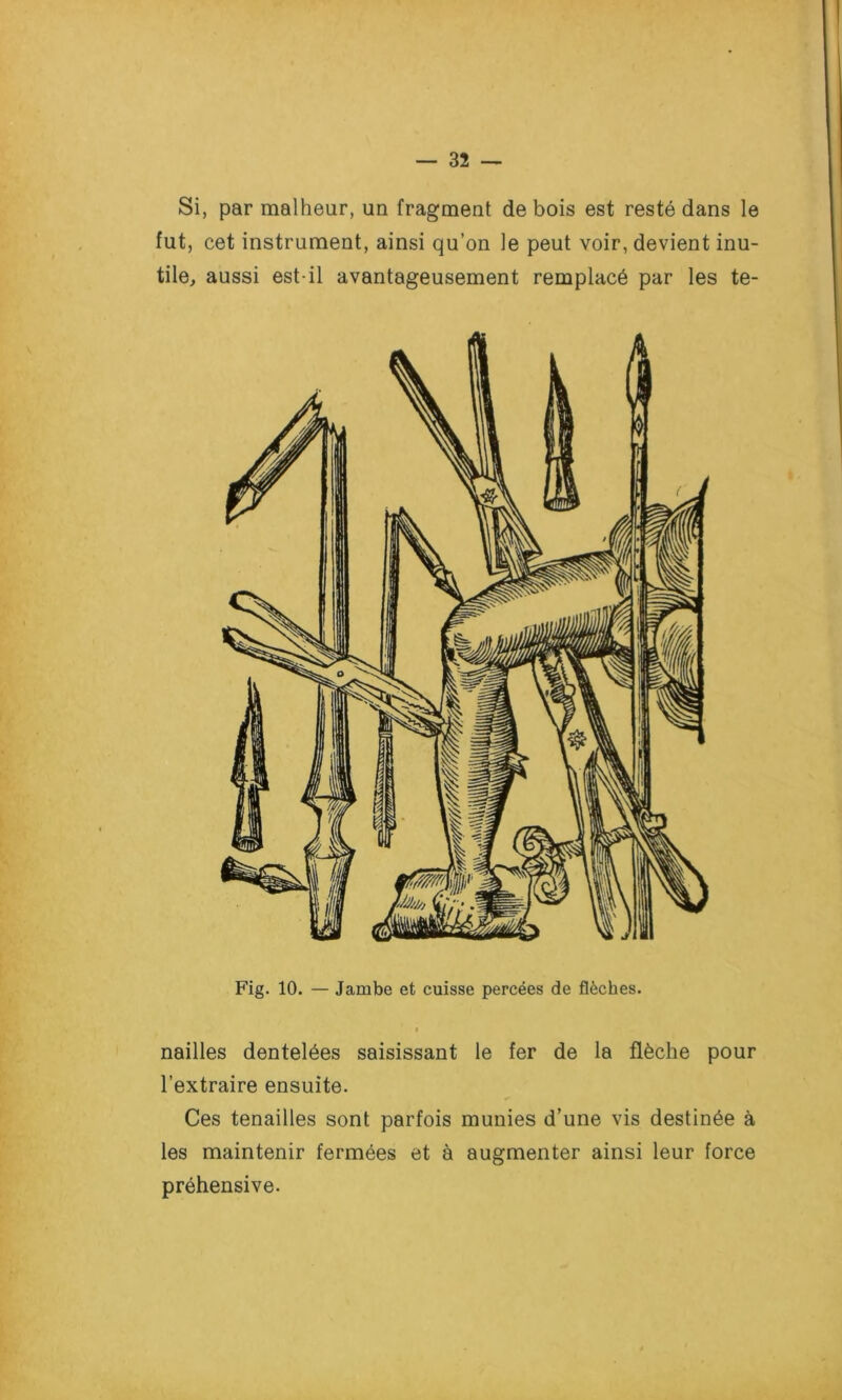 Si, par malheur, un fragment de bois est resté dans le fut, cet instrument, ainsi qu’on le peut voir, devient inu- tile, aussi est-il avantageusement remplacé par les te- Fig. 10. — Jambe et cuisse percées de flèches. » nailles dentelées saisissant le fer de la flèche pour l’extraire ensuite. Ces tenailles sont parfois munies d’une vis destinée à les maintenir fermées et à augmenter ainsi leur force préhensive.