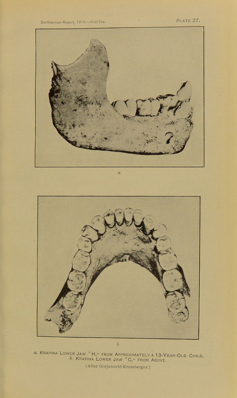 a h a. Krapina Lower Jaw “H,» from Approximately a 1 3-Year-Old Child. h. Krapina Lower Jaw “C,” from Above.