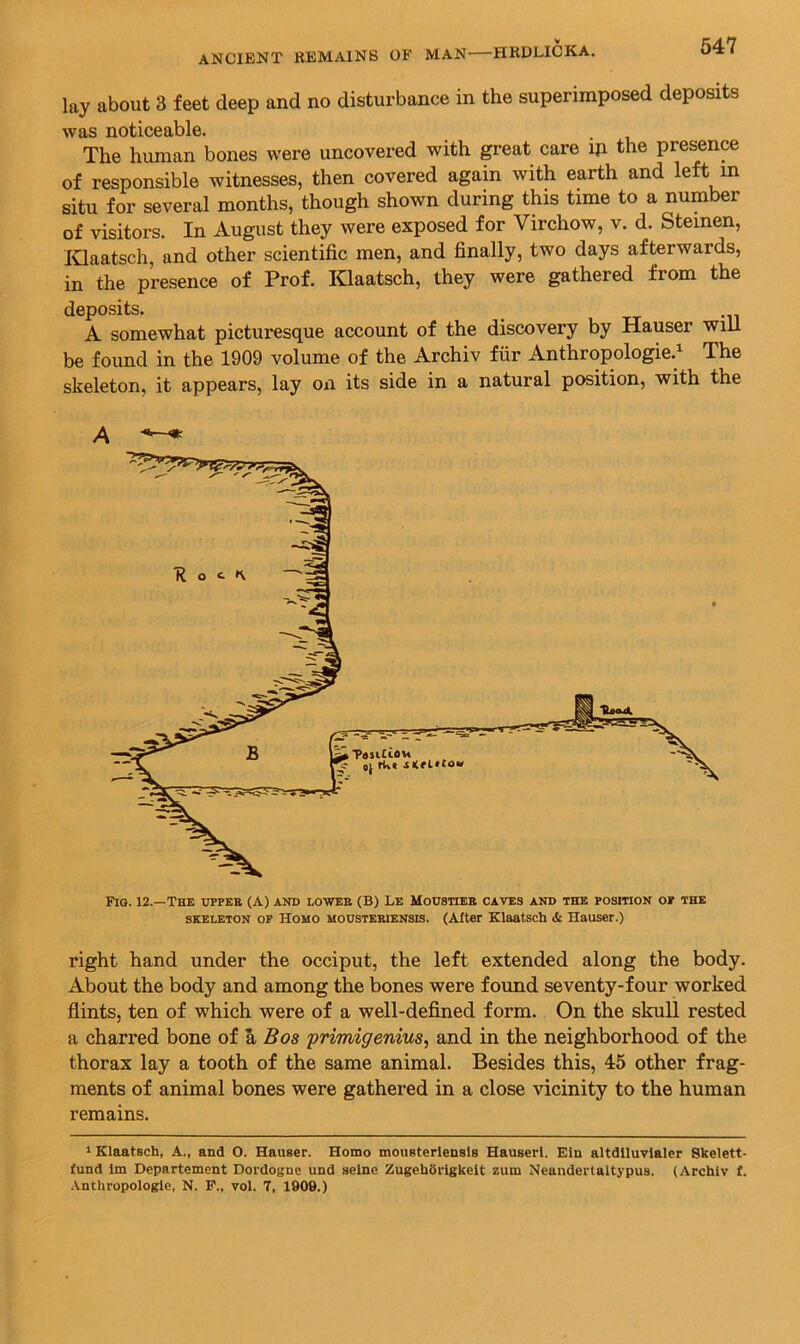 lay about 3 feet deep and no disturbance in the superimposed deposits was noticeable. The human bones were uncovered with great care iji the presence of responsible witnesses, then covered again with earth and left m situ for several months, though shown during this time to a number of visitors. In August they were exposed for Virchow, v. d. Steinen, lOaatsch, and other scientific men, and finally, two days afterwards, in the presence of Prof. Klaatsch, they were gathered from the deposits. A somewhat picturesque account of the discovery by Hauser will be found in the 1909 volume of the Archiv fiir Anthropologie.^ The skeleton, it appears, lay on its side in a natural position, with the Fio. 12.—The otpee (A) and lowee (B) Le Mohstiee caves and the position of the SKELETON OF HOMO MousTEEiENSis. (After Klaatsch & Hauser.) right hand under the occiput, the left extended along the body. About the body and among the bones were found seventy-four worked flints, ten of which were of a well-defined form. On the skull rested a charred bone of a Bos primigenius^ and in the neighborhood of the thorax lay a tooth of the same animal. Besides this, 45 other frag- ments of animal bones were gathered in a close vicinity to the human remains. I Klaatsch, A., and O. Hauser. Homo mousterlensls Hauserl. Eln altdiluvlaler Skelett- fund im Departement Dordogne und seine ZugebSiTgkeit zum Neandertaltypus. (Archiv f. .Vnthropologle, N. F., vol. 7, 1909.)