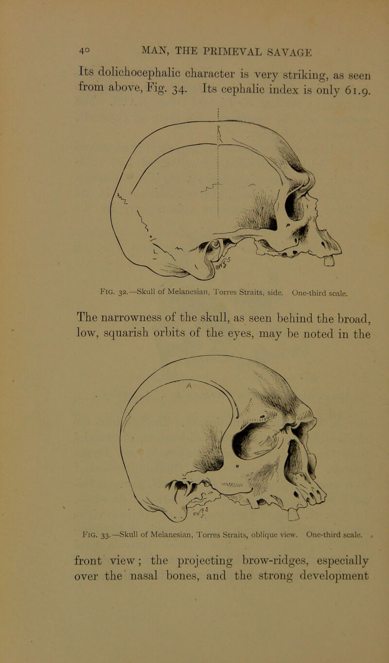Its dolichocephalic character is very striking, as seen from above, Fig. 34. Its cephalic index is only 61.9. Fig. 32.—Skull of Melanesian, Torres Straits, side. One-third scale. The narrowness of the skull, as seen behind the broad, low, squarish orbits of the eyes, may be noted in the Fig. 33.—Skull of Melanesian, Torres Straits, oblique view. One-third scale. . front view; the projecting brow-ridges, especially over the nasal bones, and the strong development