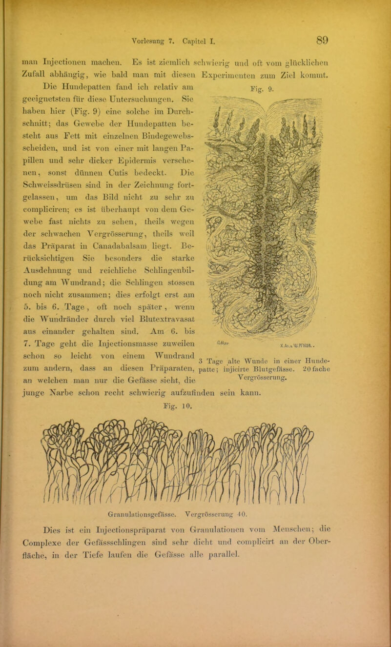 man Injectionen machen. Es ist ziemlich schwierig und oft vom glücklichen Zufall abhängig, wie bald man mit diesen Experimenten zum Ziel kommt. Die Hundepatten fand ich relativ am Pig_ 9. geeignetsten für diese Untersuchungen. Sie haben hier (Fig. 9) eine solche im Durch- schnitt; das Gewebe der Hundepatten be- steht aus Fett mit einzelnen Bindegewebs- scheiden, und ist von einer mit langen Pa- pillen und sehr dicker Epidermis versehe- nen, sonst dünnen Cutis bedeckt. Die Schweissdriisen sind in der Zeichnung fort- gelassen, um das Bild nicht zu sehr zu compliciren; es ist überhaupt von dem Ge- webe fast nichts zu sehen, tlieils wegen der schwachen Vergrössefung, tlieils weil das Präparat in Canadabalsam liegt. Be- Sie besonders die starke reichliche Schlingenbil- dung am Wundrand; die Schlingen stossen noch nicht zusammen; dies erfolgt erst am 5. bis 6. Tage, oft noch später, wenn die Wundränder durch viel Blutextravasat aus einander gehalten sind. Am 6. bis 7. Tage geht die Injectionsmasse zuweilen schon so leicht von einem Wundrand , „ , TT 3 Tage alte Wunde 111 einer Hunde- zum andern, dass an diesen Präparaten, patte; injicirte Blutgefässe. 20fache an welchen man nur die Gefässe sieht, die Yergrösserung. junge Narbe schon recht schwierig aufzufinden sein kann. Big. 10. rücksichtigen Ausdehnung und Granulationsgefässe. Yergrösserung -10. Dies ist ein Injectionspräparat von Granulationen vom Menschen; die Complexe der Gefässschlingen sind sehr dicht und compücirt an der Ober- fläche, in der Tiefe laufen die Gefässe alle parallel.