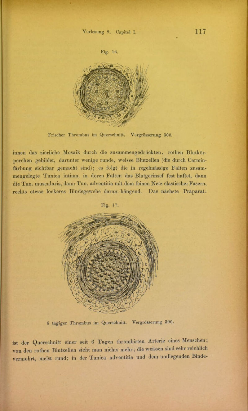 Fig. 10. Frischer Thrombus im Querschnitt. Vergrösserung S00. innen das zierliche Mosaik durch die zusammengedrückten, rothen Blutkör- perchen gebildet, darunter wenige runde, weisse Blutzellen (die durch Carmin- färbung sichtbar gemacht sind); es folgt die in regelmässige Falten zusam- mengelegte Tuniea intima, in deren Falten das Blutgerinsel fest haftet, dann die Tun. muscularis, dann Tun. adventitia mit dem feinen Netz elastischer Fasern, rechts etwas lockeres Bindegewebe daran hängend. Das nächste Präparat: Fig. 17. 6 tägiger Thrombus im Querschnitt. Vergrösserung 300. ist der Querschnitt einer seit 6 Tagen thrombirten Arterie eines Menschen; von den rothen Blutzellen sieht man nichts mehr; die weissen sind sehr reichlich vermehrt, meist rund; in der Tuniea adventitia und dem umliegenden Binde-