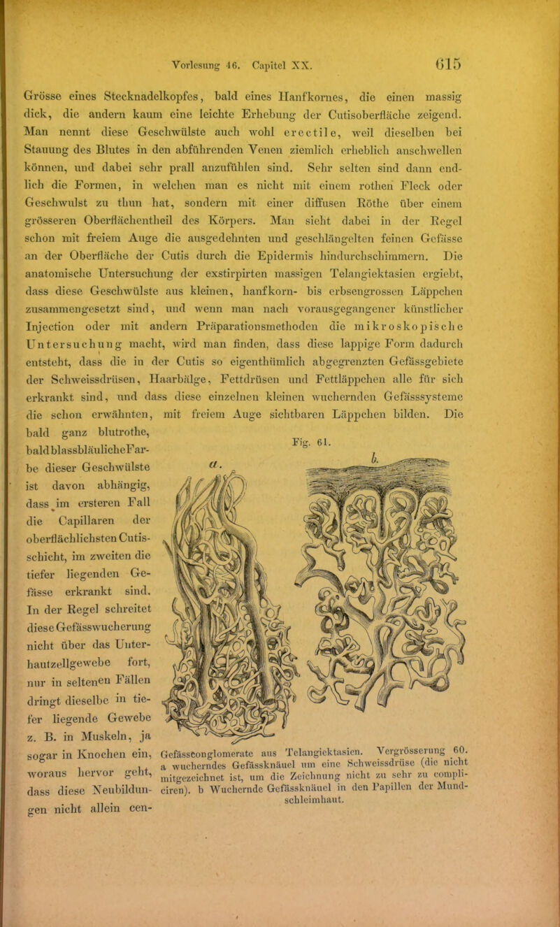 Grösse eines Stecknadelkopfes, bald eines Hanfkornes, die einen massig dick, die andern kaum eine leichte Erhebung der Cutisoberfläche zeigend. Man nennt diese Geschwülste auch wohl erectile, weil dieselben bei Stauung des Blutes in den abführenden Venen ziemlich erheblich anschwellen können, und dabei sehr prall anzufühlen sind. Sehr selten sind dann end- lich die Formen, in welchen man es nicht mit einem rothen Fleck oder Geschwulst zu thun hat, sondern mit einer diffusen Röthe über einem grösseren Oberflächentheil des Körpers. Man sieht dabei in der Regel schon mit freiem Auge die ausgedehnten und geschlängelten feinen Gefässe an der Oberfläche der Cutis durch die Epidermis hindurchschimmern. Die anatomische Untersuchung der exstirpirten massigen Telangiektasien ergiebt, dass diese Geschwülste aus kleinen, hanfkorn- bis erbsengrossen Läppchen zusammengesetzt sind, und wenn man nach vorausgegangener künstlicher Injection oder mit andern Präparationsmethoden die mikroskopische Untersuchung macht, wird man finden, dass diese lappige Form dadurch entsteht, dass die in der Cutis so eigenthümlich abgegrenzten Gefässgebiete der Schweissdrüsen, Haarbälge, Fettdrüsen und Fettläppchen alle für sich erkrankt sind, ixnd dass diese einzelnen kleinen wuchernden Gefässsysteme die schon erwähnten, bald ganz blutrothe, baldblassbläulicheF ar- be dieser Geschwülste ist davon abhängig, dass im ersteren Fall % die Capillaren der oberflächlichsten Cutis- schicht, im zweiten die tiefer liegenden Ge- fässe erkrankt sind. In der Regel schreitet diese Gefässwucherung nicht über das Unter- hautzellgewebe fort, nur in seltenen Fällen dringt dieselbe in tie- fer liegende Gewebe z. B. in Muskeln, ja sogar in Knochen ein, woraus hervor geht, dass diese Neubildun- gen nicht allein cen- mit freiem Auge sichtbaren Läppchen bilden. Die Fig. 61. GefässConglomeratc aus Telangiektasien. Vergrösserung 60. a wucherndes Gefässknäuel um eine Schweissdrüse (die nicht lnitgezeichnet ist, um die Zeichnung nicht zu sehr zu conjpli- ciren). b Wuchernde Gefässknäuel in den Papillen der Mund- schleimhaut.