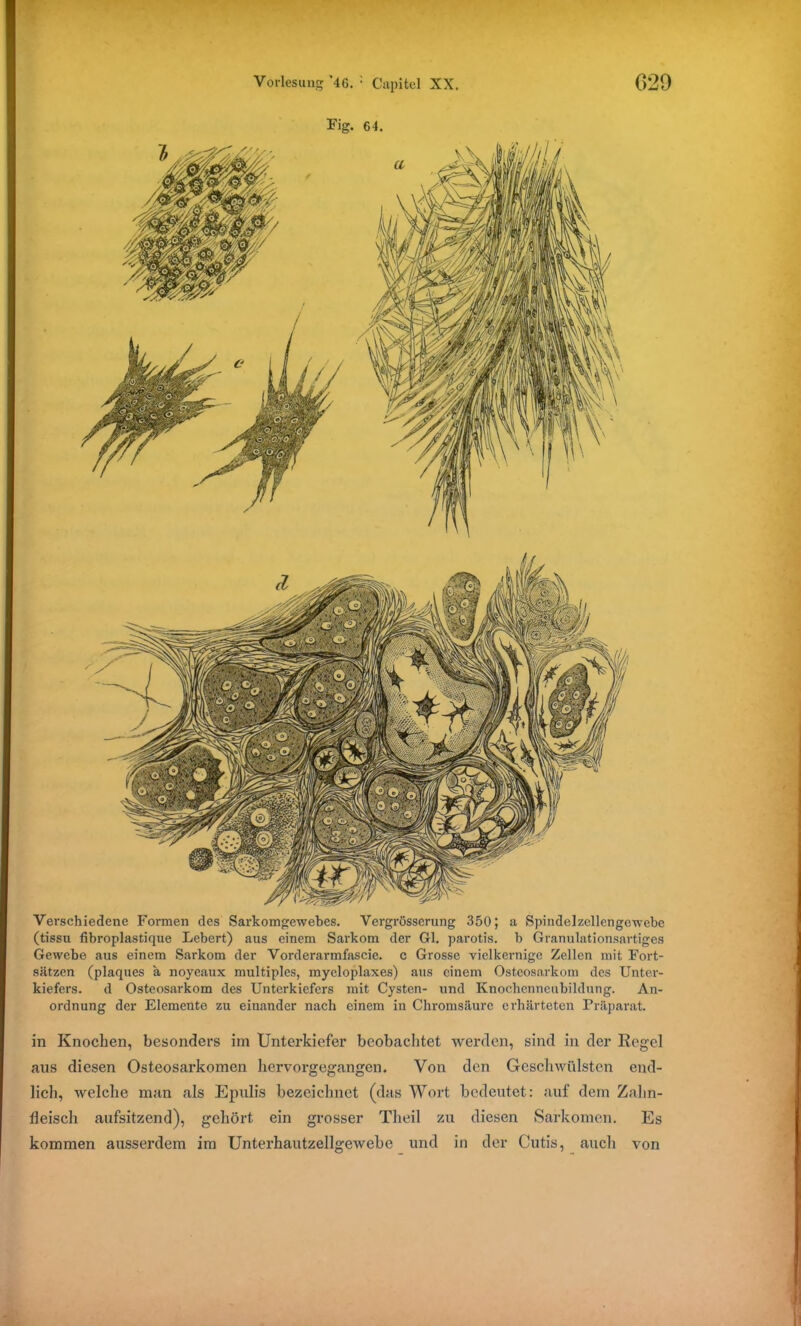 Eig. 64. Verschiedene Formen des Sarkomgewebes. Vergrösserung 350; a Spindelzellcngewebe (tissu fibroplastique Lebert) aus einem Sarkom der Gl. parotis, b Granulationsartiges Gewebe aus einem Sarkom der Vorderarmfascie. c Grosse vielkernige Zellen mit Fort- sätzen (plaques a noyeaux multiples, myeloplaxes) aus einem Osteosarkom des Unter- kiefers. d Osteosarkom des Unterkiefers mit Cysten- und Knochcnncubildung. An- ordnung der Elemente zu einander nach einem in Chromsäurc erhärteten Präparat. in Knochen, besonders im Unterkiefer beobachtet werden, sind in der Kegel aus diesen Osteosarkomen hervorgegangen. Von den Geschwülsten end- lich, welche man als Epulis bezeichnet (das Wort bedeutet: auf dem Zahn- fleisch aufsitzend), gehört ein grosser Theil zu diesen Sarkomen. Es kommen ausserdem im Unterhautzellgewebe und in der Cutis, auch von