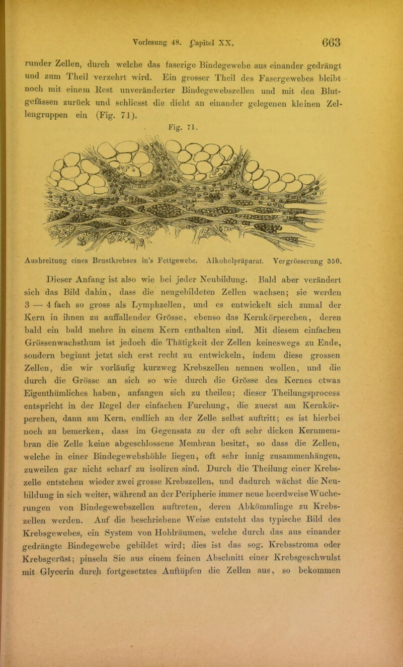 runder Zellen, durch welche das faserige Bindegewebe aus einander gedrängt und zum Iheil verzehrt wird. Ein grosser Theil des Fasergewebes bleibt noch mit einein Kost unveränderter Bindegewebszellen und mit den Blut- gefässen zurück und schlicsst die dicht an einander gelegenen kleinen Zel- lengruppen ein (Fig. 71). Fig. 71. Ausbreitung eines Brustkrebses in’s Fettgewebe. Alkoholpräparat. Vcrgrosscrung 350. Dieser Anfang ist also wie bei jeder Neubildung. Bald aber verändert sich das Bild dahin, dass die neugebildeten Zellen wachsen; sie werden 3 — 4 fach so gross als Lymphzellen, und es entwickelt sich zumal der Kern in ihnen zu auffallender Grösse, ebenso das Kernkörperchen, deren bald ein bald mehre in einem Kern enthalten sind. Mit diesem einfachen Grössenwachsthum ist jedoch die Thätigkeit der Zellen keineswegs zu Ende, sondern beginnt jetzt sich erst recht zu entwickeln, indem diese grossen Zellen, die wir vorläufig kurzweg Krebszellen nennen wollen, und die durch die Grösse an sich so wie durch die Grösse des Kernes etwas Eigenthiimliches haben, anfangen sich zu theilen; dieser Theilungsprocess entspricht in der Regel der einfachen Furchung, die zuerst am Kernkör- perchen, dann am Kern, endlich an der Zelle selbst auftritt; es ist hierbei noch zu bemerken, dass im Gegensatz zu der oft sehr dicken Kernmem- bran die Zelle keine abgeschlossene Membran besitzt, so dass die Zellen, welche in einer Bindegewebshöhle liegen, oft sehr innig Zusammenhängen, zuweilen gar nicht scharf zu isoliren sind. Durch die Theilung einer Krebs- zelle entstehen wieder zwei grosse Krebszellen, und dadurch wächst die Neu- bildung in sich weiter, während an der Peripherie immer neue heerdweise Wuche- rungen von Bindegewebszellen auftreten, deren Abkömmlinge zu Krebs- zellen werden. Auf die beschriebene Weise entsteht das typische Bild des Krebsgewebes, ein System von Hohlräumen, welche durch das aus einander gedrängte Bindegewebe gebildet wird; dies ist das sog. Krebsstroma oder Krebsgerüst; pinseln Sie aus einem feinen Abschnitt einer Krebsgeschwulst mit Glycerin durch fortgesetztes Auftüpfen die Zellen aus, so bekommen