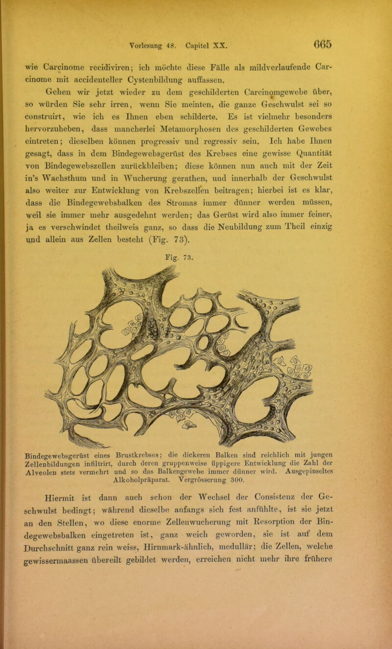 wie Carcinome recidiviren; ich möchte diese Fälle als mildverlaufende Car- cinome mit accidenteller Cystenbildung auffassen. Gehen wir jetzt wieder zu dem geschilderten Carcinomgewebe über, so würden Sie sehr irren, wenn Sie meinten, die ganze Geschwulst sei so construirt, wie ich es Ihnen eben schilderte. Es ist vielmehr besonders hervorzuheben, dass mancherlei Metamorphosen des geschilderten Gewebes eintreten; dieselben können progressiv und regressiv sein. Ich habe Ihnen gesagt, dass in dem Bindegewebsgerüst des Krebses eine gewisse Quantität von Bindegewebszellen Zurückbleiben; diese können nun auch mit der Zeit in’s Wachsthum und in Wucherung gerathen, und innerhalb der Geschwulst also weiter zur Entwicklung von Krebszellen beitragen; hierbei ist es klar, dass die Bindegewebsbalken des Stromas immer dünner werden müssen, weil sie immer mehr ausgedehnt werden; das Gerüst wird also immer feiner, ja es verschwindet theilweis ganz, so dass die Neubildung zum Theil einzig und allein aus Zellen besteht (Fig. 73). Fig. 73. Bindegewebsgerüst eines Brustkrebses; die dickeren Balken sind reichlich mit jungen Zellenbildungen infiltrirt, durch deren gruppenweise üppigere Entwicklung die Zahl der Alveolen stets vermehrt und so das Balkcngewebe immer dünner wird. Ausgepinseltes Alkoholpräparat. Vergrösserung 300. Hiermit ist dann auch schon der Wechsel der Consistenz der Ge- schwulst bedingt; während dieselbe anfangs sich fest anfühlte, ist sie jetzt an den Stellen, wo diese enorme Zellenwucherung mit Resorption der Bin- degewebsbalken eingetreten ist, ganz weich geworden, sie ist auf dem Durchschnitt ganz rein weiss, Hirnmark-ähnlich, medullär; die Zellen, welche gewissermaassen übereilt gebildet werden, erreichen nicht mehr ihre frühere