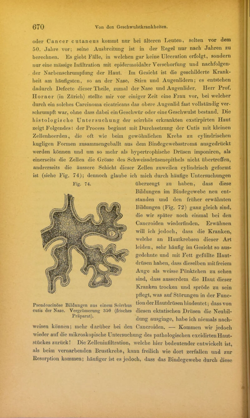 oder Cancer cutaneus kommt nur bei älteren Leuten, selten vor dem 50. Jahre vor; seine Ausbreitung ist in der Regel nur nach Jahren zu berechnen. Es gieht Fälle, in welchen gar keine Ulceration erfolgt, sondern nur eine massige Infiltration mit epidermoidaler Verschorfung und nachfolgen- der Narbenschrumpfung der Haut. Im Gesicht ist die geschilderte Krank- heit am häufigsten, so an der Nase, Stirn und Augenlidern; es entstehen dadurch Defecte dieser Theile, zumal der Nase und Augenlider. Herr Prof. Horner (in Zürich) stellte mir vor einiger Zeit eine Frau vor, bei welcher durch ein solches Carcinoma cicatricans das obere Augenlid fast vollständig ver- schrumpft war, ohne dass dabei ein Geschwür oder eine Geschwulst bestand. Die histologische Untersuchung der scirrhös erkrankten exstirpirten Haut zeigt Folgendes: der Process beginnt mit Durchsetzung der Cutis mit kleinen Zellenheerden, die oft wie beim gewöhnlichen Krebs zu cylindrischen kugligen Formen zusammengeballt aus dem Bindcgewebsstromä ausgedrückt werden können und um so mehr als hypertrophische Drüsen imponiren, als einerseits die Zellen die Grösse des Schweissdrüsenepithels nicht übertreffen, andrerseits die äussere Schicht dieser Zellen zuweilen cylindrisch geformt ist (siehe Fig. 74); dennoch glaube ich mich durch häufige Untersuchungen Fig. 74. überzeugt zu haben, dass diese Bildungen im Bindegewebe neu ent- standen und den früher erwähnten Bildungen (Fig. 72) ganz gleich sind, die wir später noch einmal bei den Cancroiden wiederfinden. Erwähnen will ich jedoch, dass die Kranken, welche an Hautkrebsen dieser Art leiden, sehr häufig im Gesicht so aus- gedehnte und mit Fett gefüllte Haut- drüsen haben, dass dieselben mit freiem Auge als weisse Pünktchen zu sehen sind, dass ausserdem die Haut dieser Kranken trocken und spröde zu sein pflegt, was auf Störungen in der Func- Pseudoacinöse Bildungen aus einem Scirrhus ^on c^ei Hautdi üsen hindeutet; dass von cutis der Nase. Vergrössevung 350 (frisches diesen ektatischen Drüsen die Neubil- Piäpaiat). düng ausginge, habe ich niemals nach- wcisen können; mehr darüber bei den Cancroiden. •— Kommen wir jedoch Wieder auf die mikroskopische Untersuchung des pathologischen excidirtenHaut- stückes zurück! Die Zelleninfiltration, welche hier bedeutender entwickelt ist, als beim vernarbenden Brustkrebs, kann freilich wie dort zerfallen und zur Resorption kommen; häufiger ist cs jedoch, dass das Bindegewebe durch diese