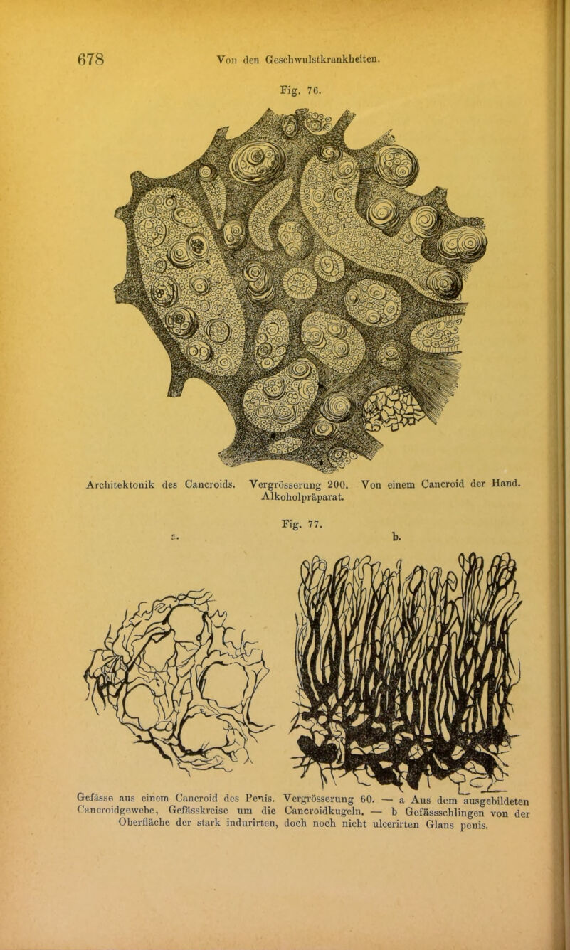 Architektonik des Cancroids. Vcrgrösserung 200. Von einem Cancroid der Hand. Alkoholpräparat. Fig. 77. f • b. Gefässe aus einem Cancroid des Penis. Vergrösserung 60. — a Aus dem ausgebildeten Cancroidgewcbe, Gefässkrcisc um die Cancroidkugeln. — b Gefässschlingen von der Oberfläche der stark indurirten, doch noch nicht ulcerirten Glans penis.