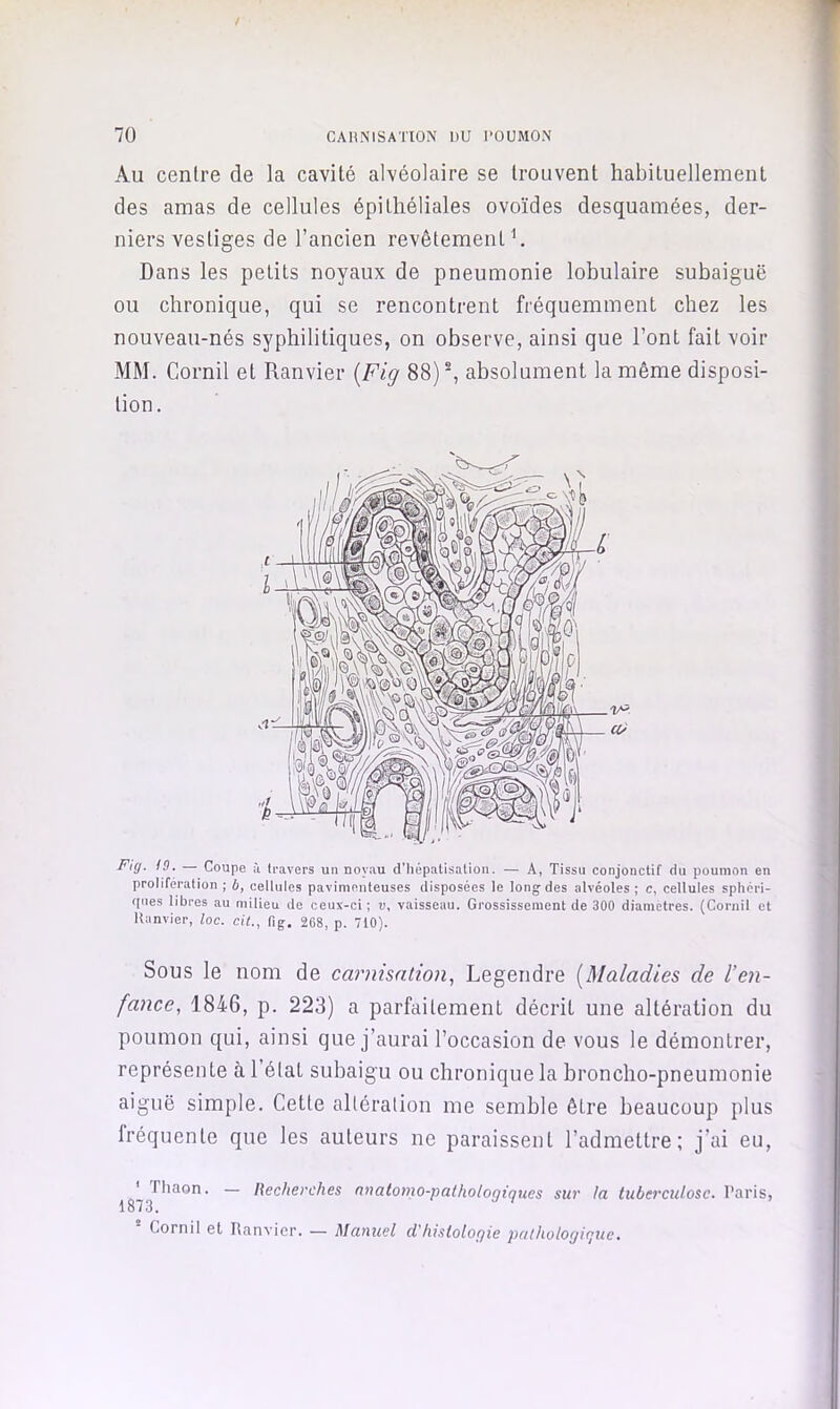 Au centre de la cavité alvéolaire se trouvent habituellement des amas de cellules épithéliales ovoïdes desquamées, der- niers vestiges de l’ancien revêtement ^ Dans les petits noyaux de pneumonie lobulaire subaiguë ou chronique, qui se rencontrent fréquemment chez les nouveau-nés syphilitiques, on observe, ainsi que l’ont fait voir MM. Cornil et Ranvier [Fig 88) ^ absolument la même disposi- tion. Fig. 19. — Coupe ù travers un noyau d’Iiépatisalion. — A, Tissu conjonctif du poumon en prolifération; b, cellules pavimenteuses disposées le long des alvéoles; c, cellules sphéri- ques libres au milieu de ceux-ci ; v, vaisseau. Grossissement de 300 diamètres. (Cornil et lUinvier, loc. cit., fig. 268, p. 710). Sous le nom de carnisation, Legendre [Maladies de l’en- fance, 1846, p. 223) a parfaitement décrit une altération du poumon qui, ainsi que j’aurai l’occasion de vous le démontrer, représente à l’état subaigu ou chronique la broncho-pneumonie aiguë simple. Cette altération me semble être beaucoup plus fréquente que les auteurs ne paraissent l’admettre; j’ai eu, ' riiaon. — Recherches nnatomo-palholoqiques sur fa tuberculose. Paris, 1873. Cornil et Ranvier. — Manuel d'filsloloqie pathologique.