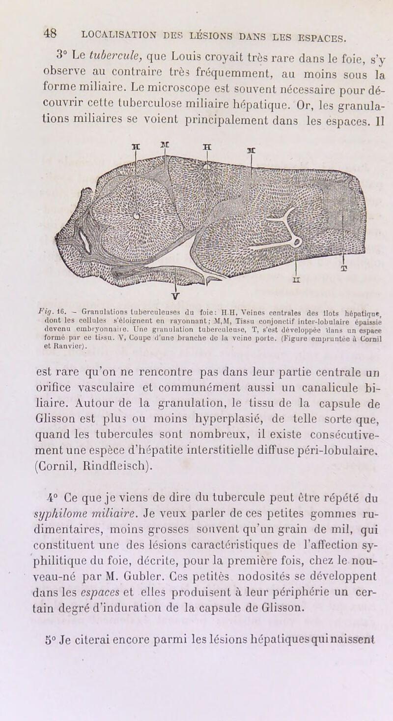 3° Le tubercule, que Louis croyait très rare dans le foie, s’y observe au contraire très fréquemment, au moins sous la forme miliaire. Le microscope est souvent nécessaire pour dé- couvrir cette tuberculose miliaire hépatique. Or, les granula- tions miliaires se voient principalement dans les espaces. 11 Ei'fl. IG. - Granulations tuberculeuses du foie: H.H, Veines centrales des Ilots hépatique, dont les cellules s'éloignent en rayonnant; M,M, Tissu conjonctif inter-lobulaire épaissie devenu embryonnaiie. Une granulation tuberculeuso, T, s’est développée 'dans un espace formé par ce tissu. V, Coupe d’une blanche de la veine poite. (Figure empruntée à Corail et Ranvier). est rare qu’on ne rencontre pas dans leur partie centrale un orifice vasculaire et communément aussi un canalicule bi- liaire. Autour de la granulation, le tissu de la capsule de Glisson est plus ou moins hyperplasié, de telle sorte que, quand les tubercules sont nombreux, il existe consécutive- ment une espèce d’hépatite interstitielle diffuse péri-lobulaire. (Gornil, Rindfleisch). 4° Ce que je viens de dire du tubercule peut être répété du syphilome miliaire. Je veux parler de ces petites gommes ru- dimentaires, moins grosses souvent qu’un grain de mil, qui constituent une des lésions caractéristiques de l’affection sy- philitique du foie, décrite, pour la première fois, chez le nou- veau-né par M. Gubler. Ces petitès nodosités se développent dans les espaces et elles produisent à leur périphérie un cer- tain degré d’induration de la capsule de Glisson. 5° Je citerai encore parmi les lésions hépatiques qui naissent